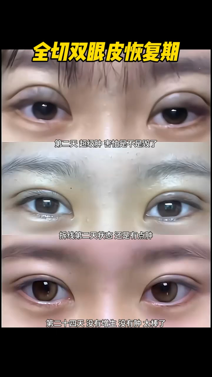 全切双眼皮术后恢复效果