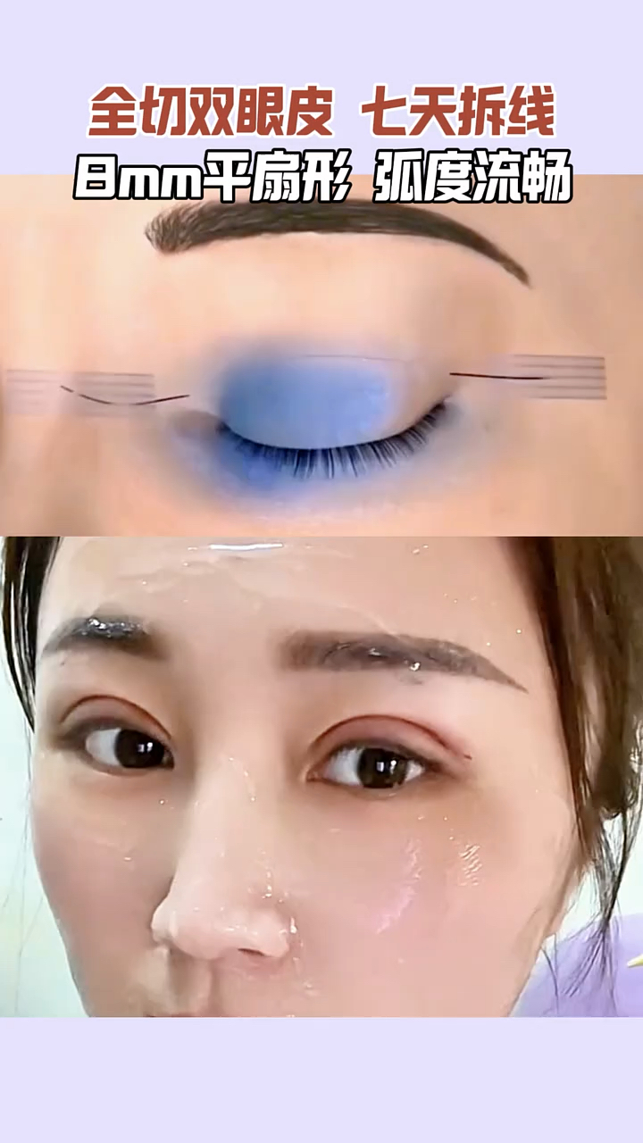 全切双眼皮8mm平扇形