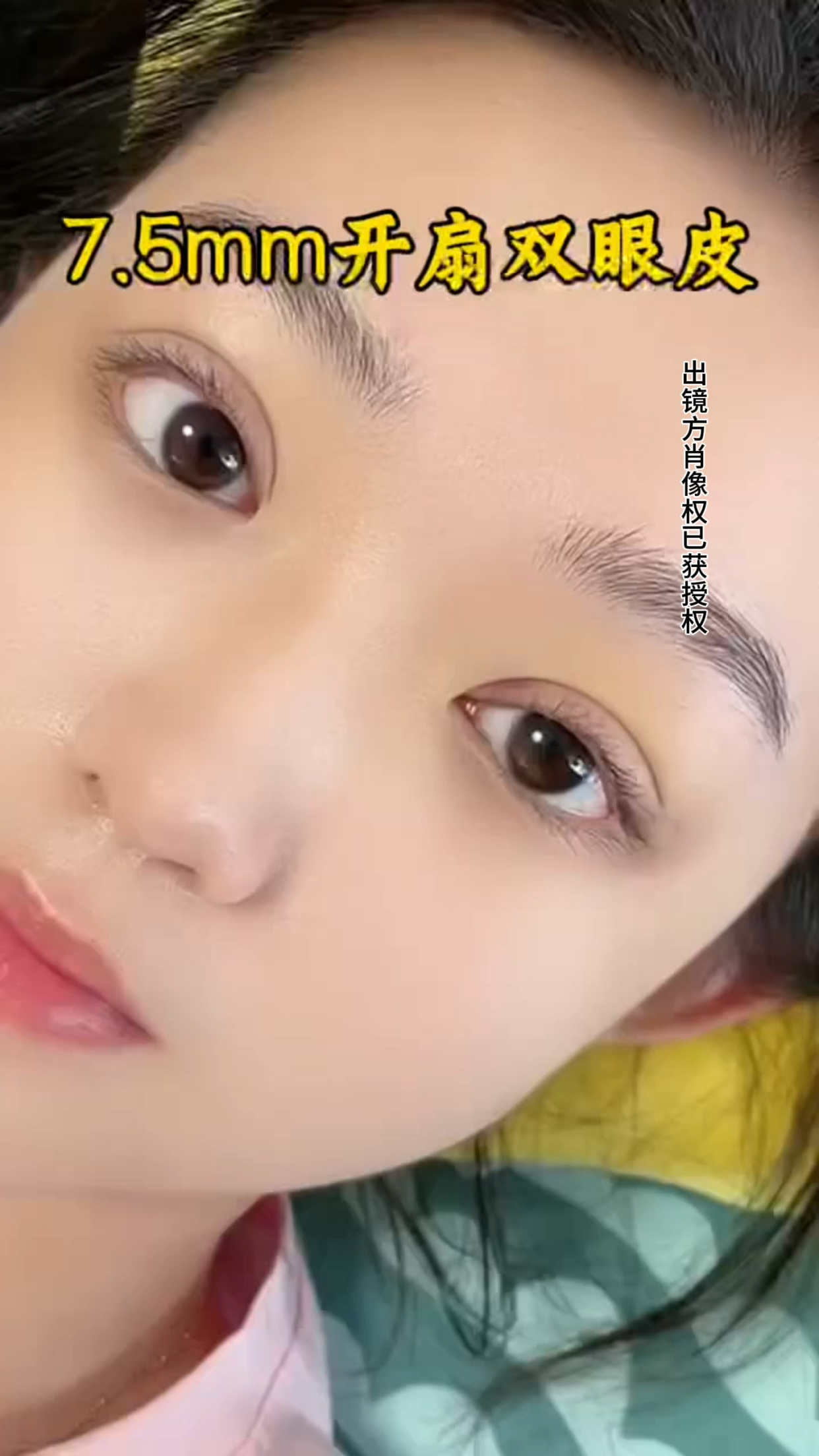 7.5mm平扇双眼皮术后效果