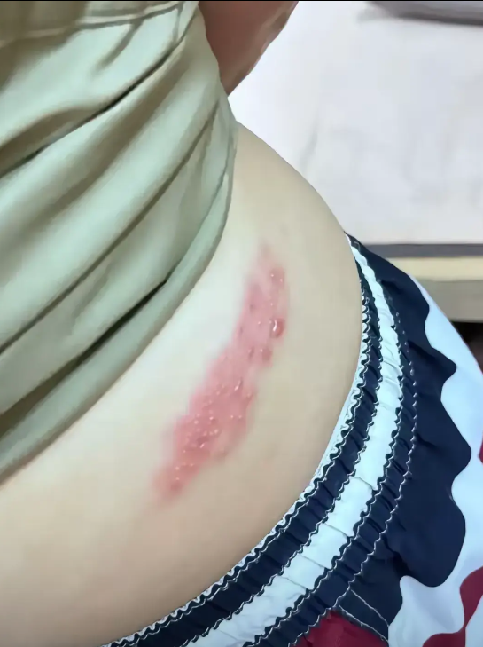 这皮肤病啊,痒起来那真的是要命,是那种深入骨髓的痒,而且还伴随着