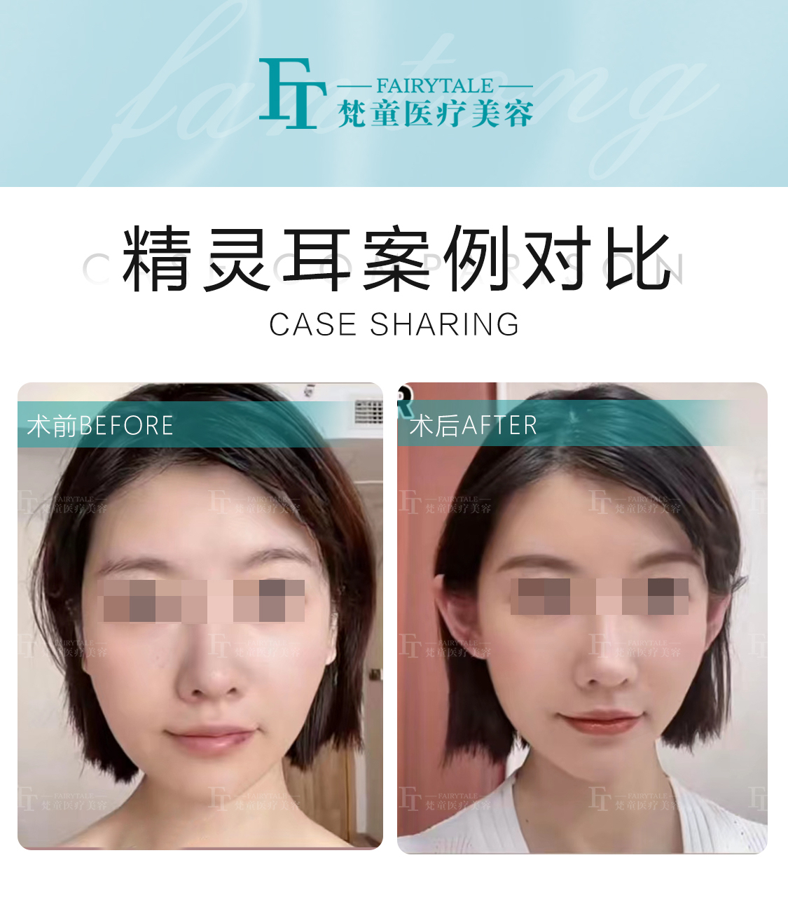 想要拍照360度无死角?精灵耳注射即刻