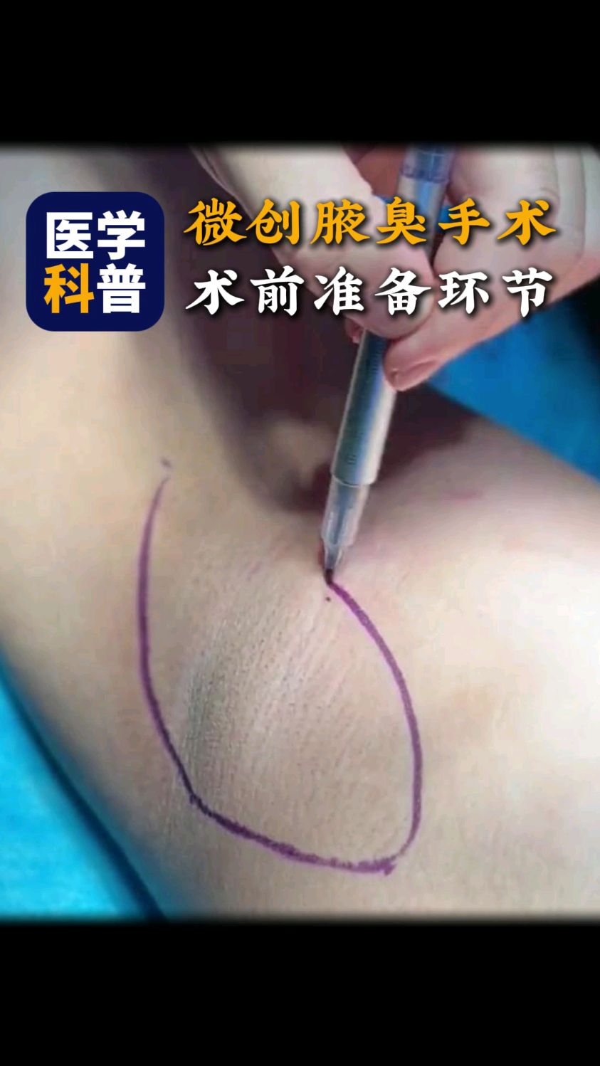 有狐臭怎么办永久去掉狐臭为什么在线 有狐臭怎么办永久去掉狐臭为什么在线