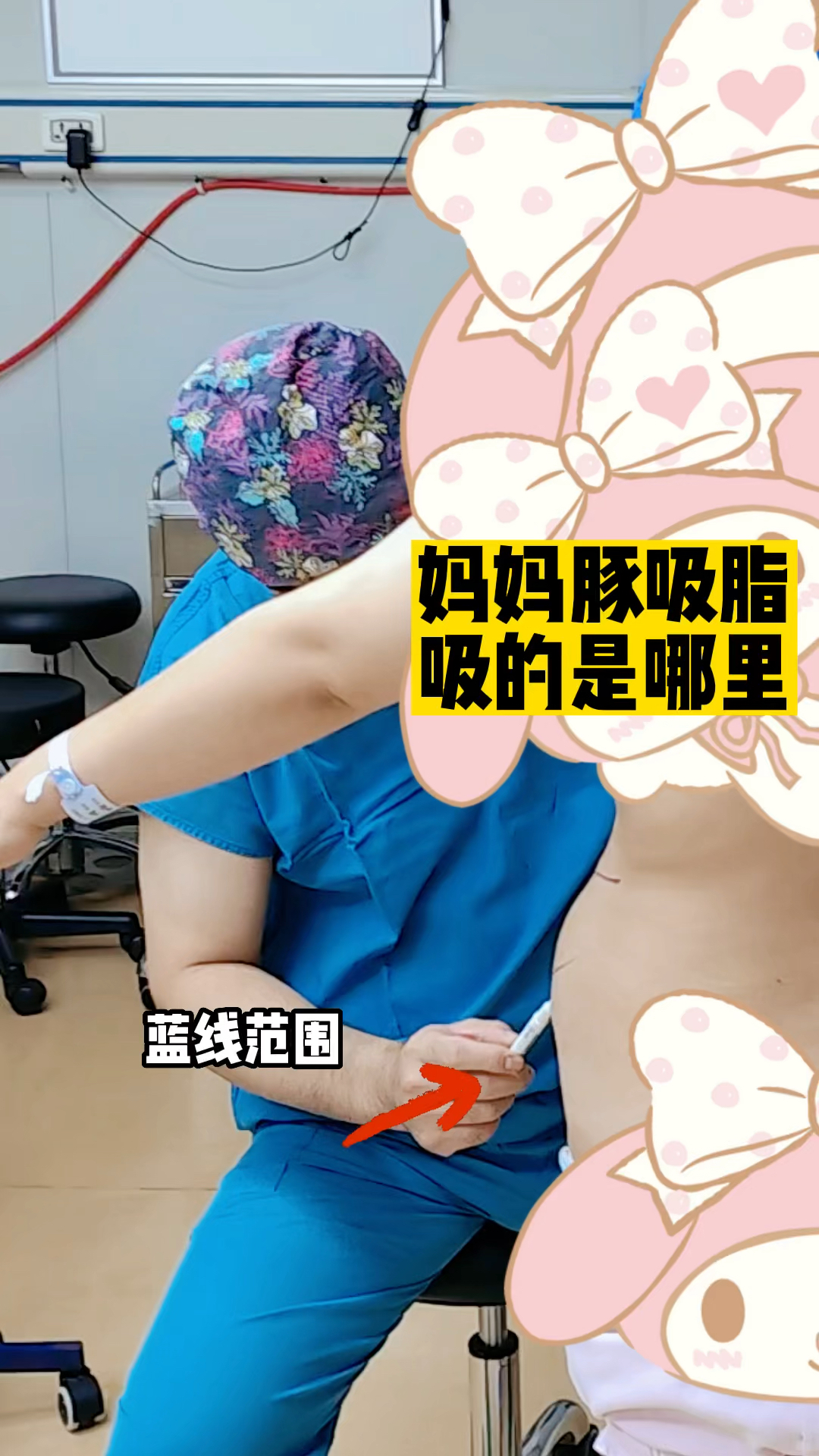 妈妈臀吸脂 吸得是哪里