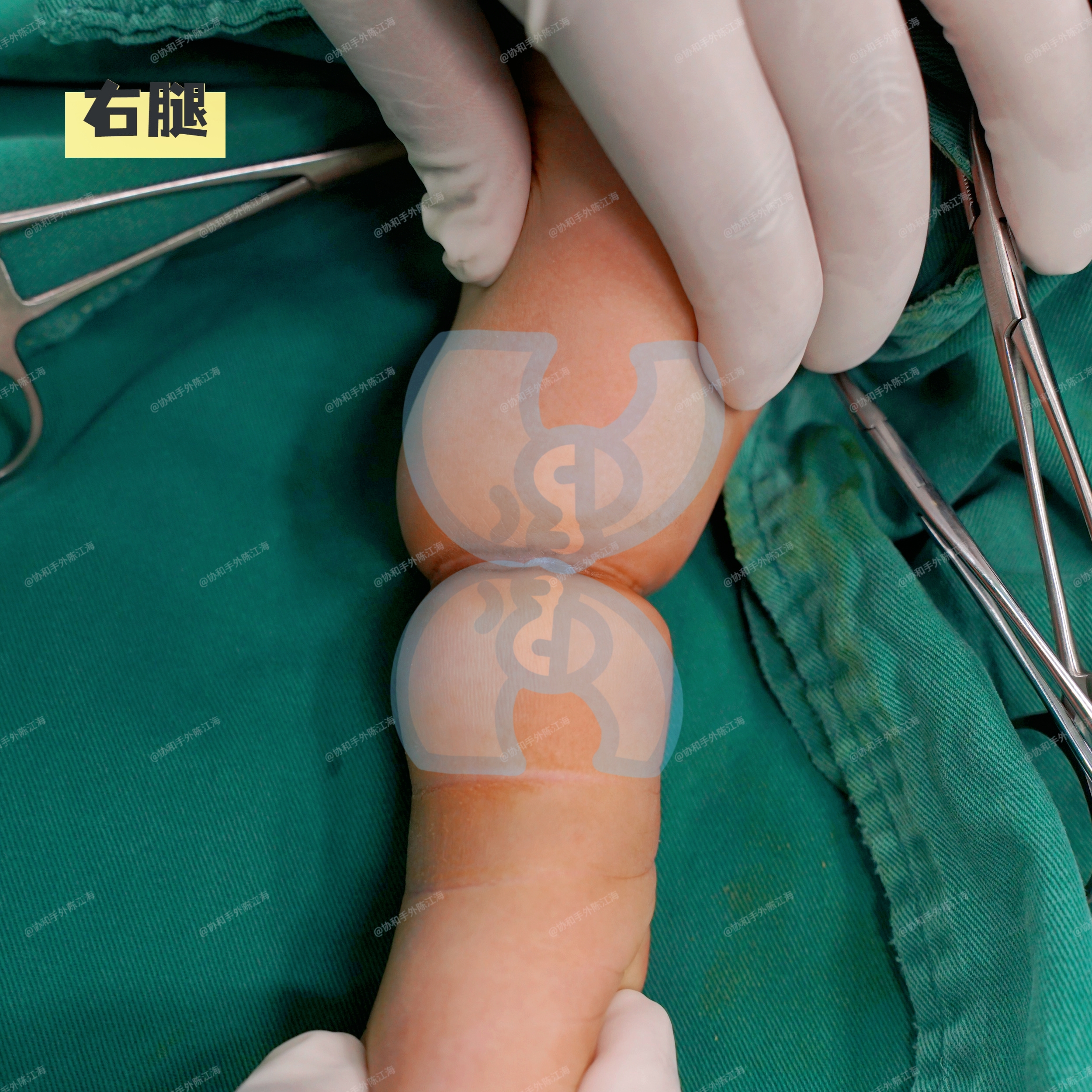 这种疾病叫做束带综合征,宝宝出生后伤