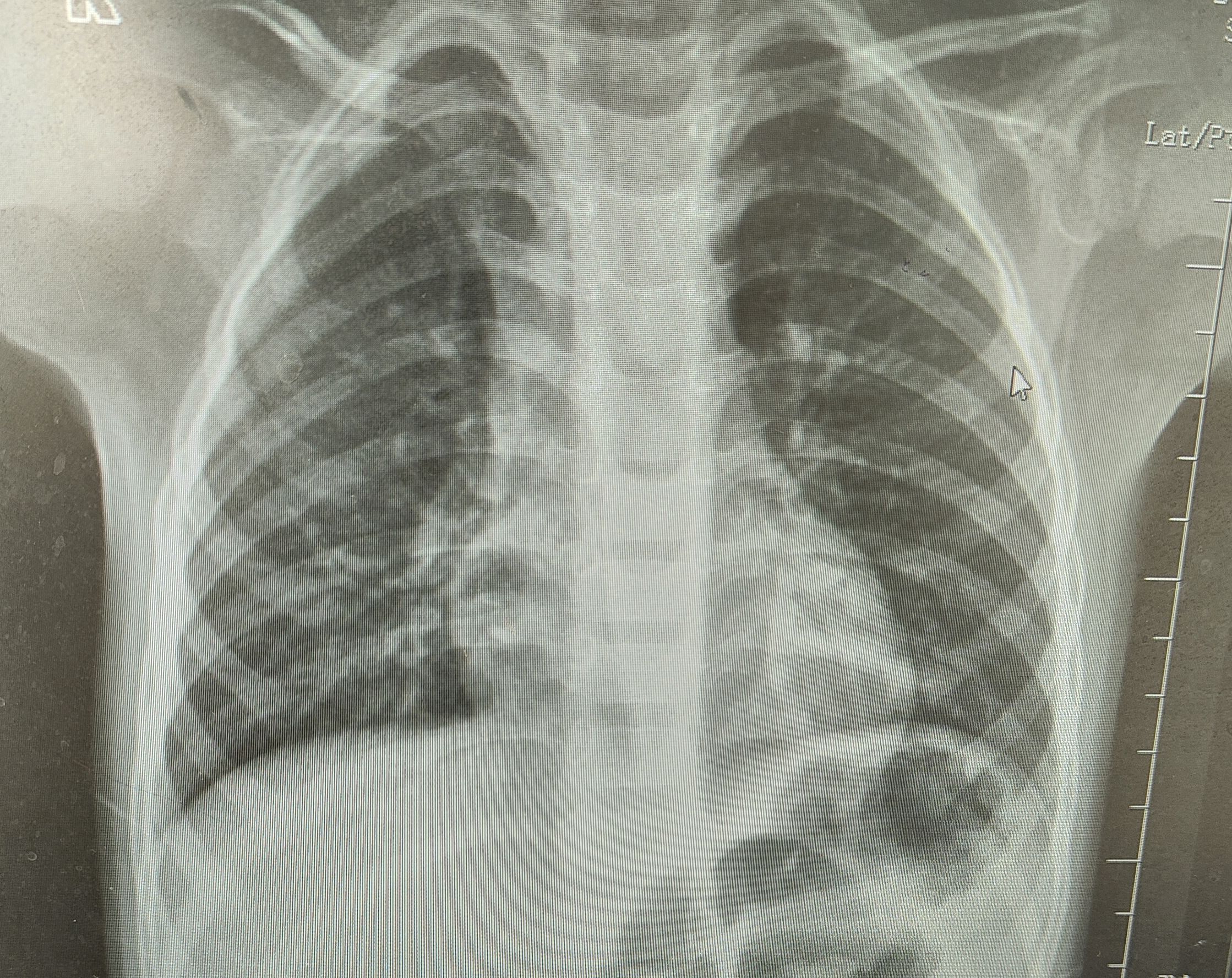 孩子发热咳嗽,应该怎么样检查治疗