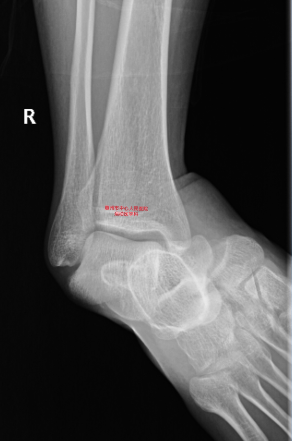 崴脚能有多严重?