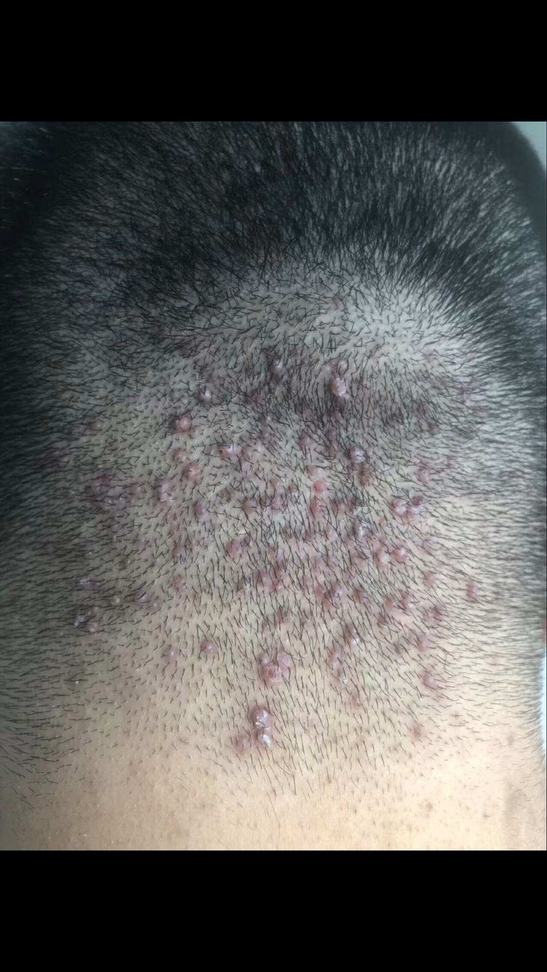 马拉色菌毛囊炎治疗前后对比图