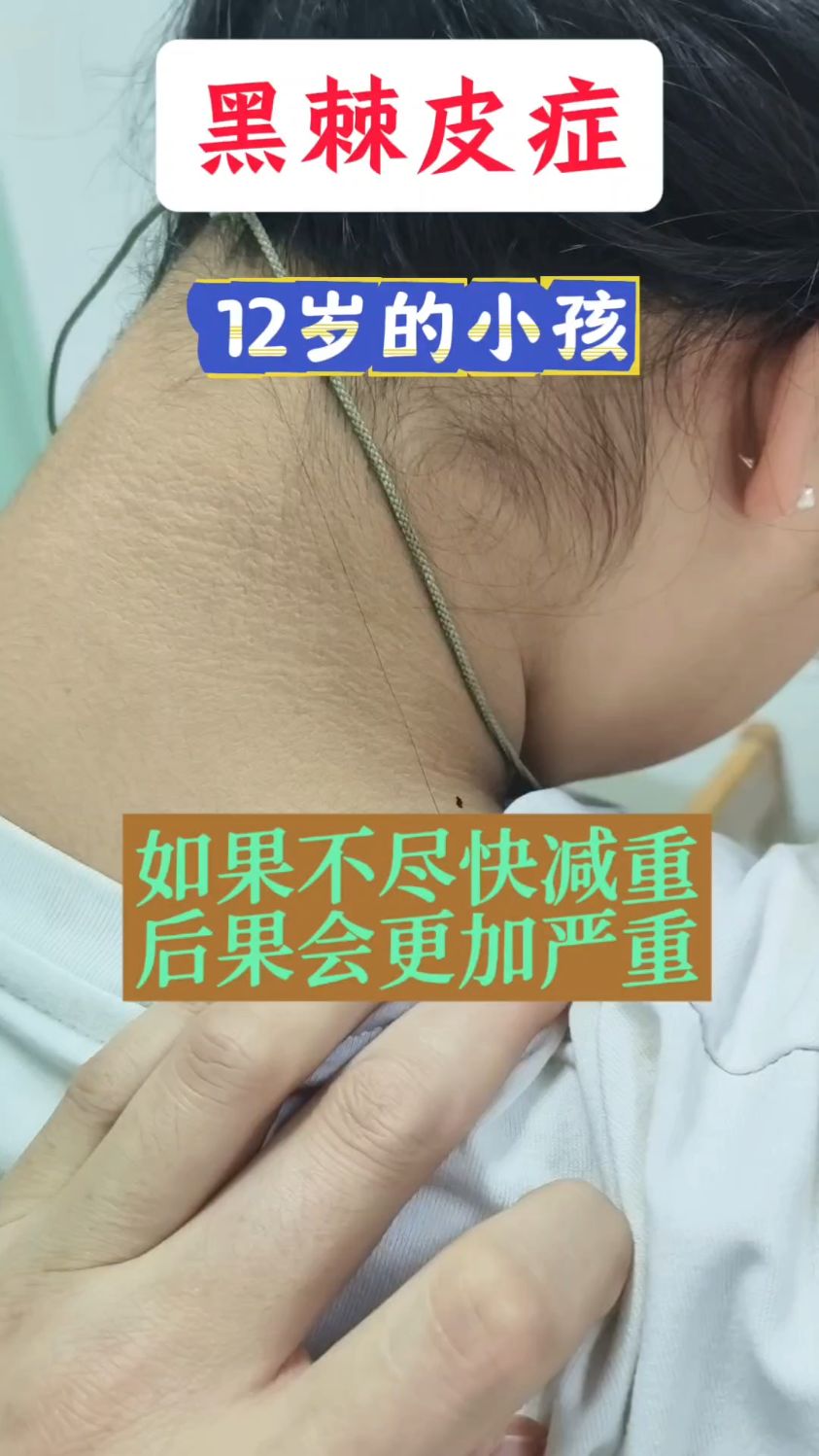 12岁的小姑娘,因为肥胖出现了黑棘皮