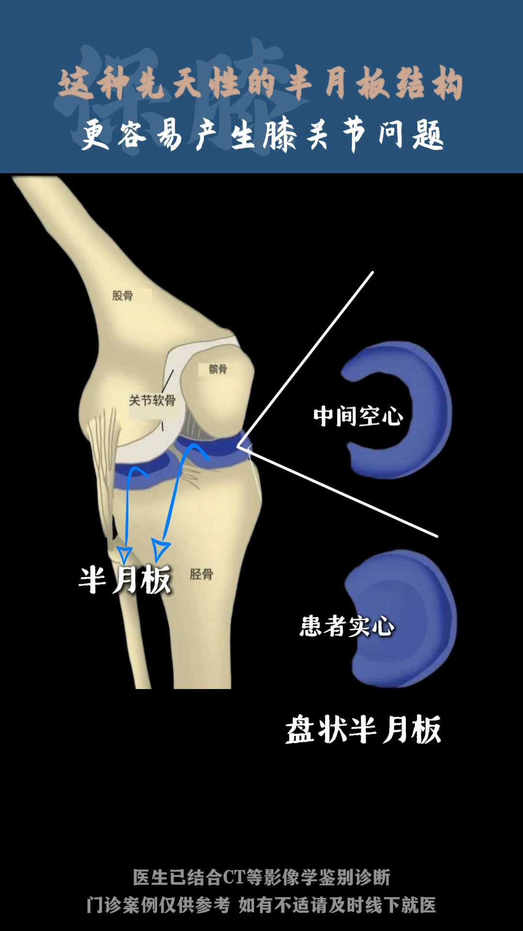 这种先天性的半月板,更容易产生膝关节问题!
