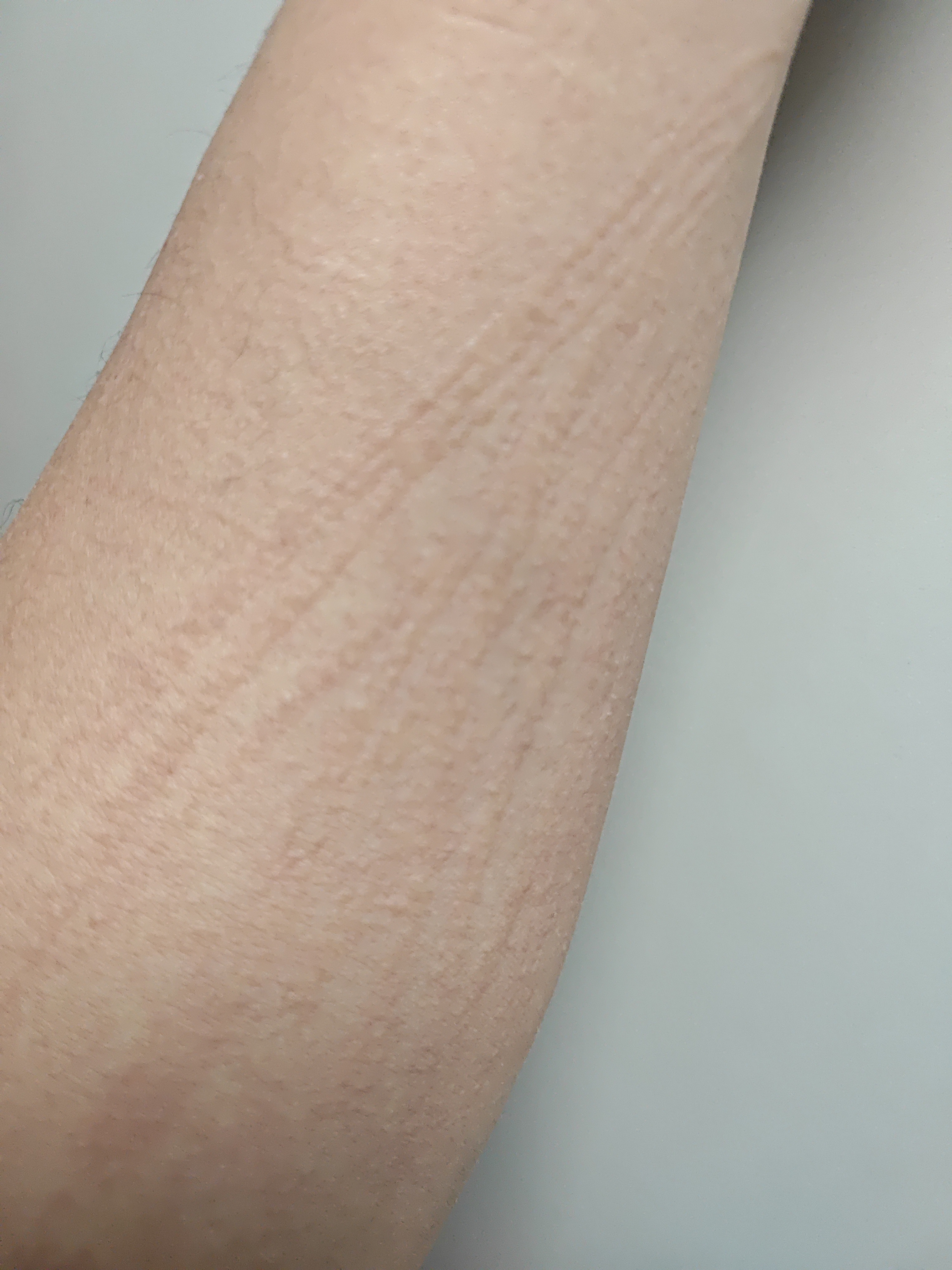 为什么突然对鸡蛋过敏?为什么在线 为什么突然对鸡蛋过敏?为什么在线