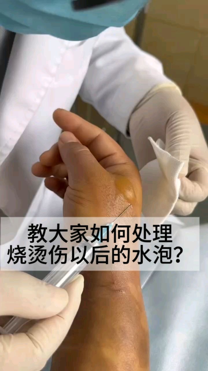 教大家如何正确处理烧烫伤后的水泡
