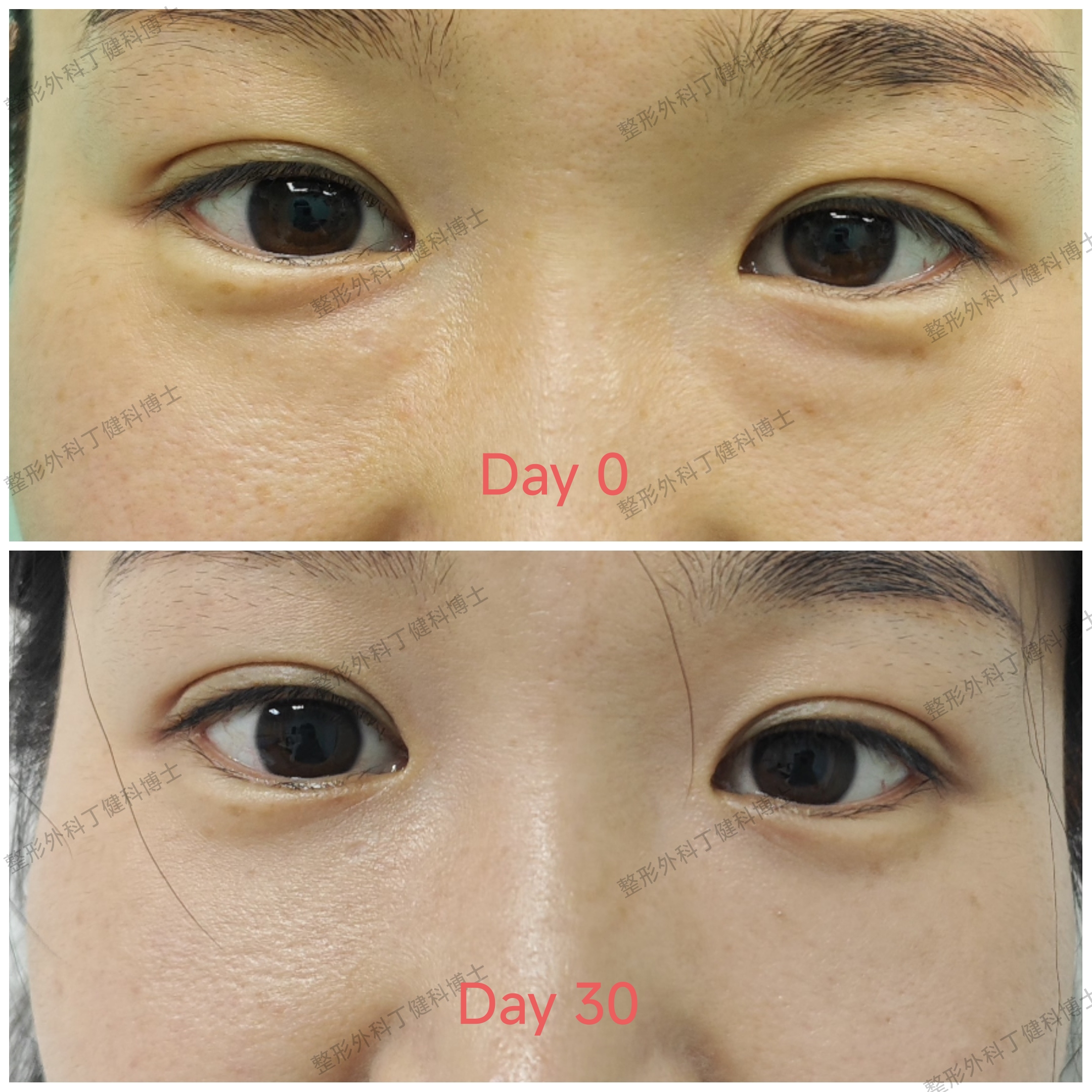 【单内切眼袋30天】什么样的眼袋适合单内切?