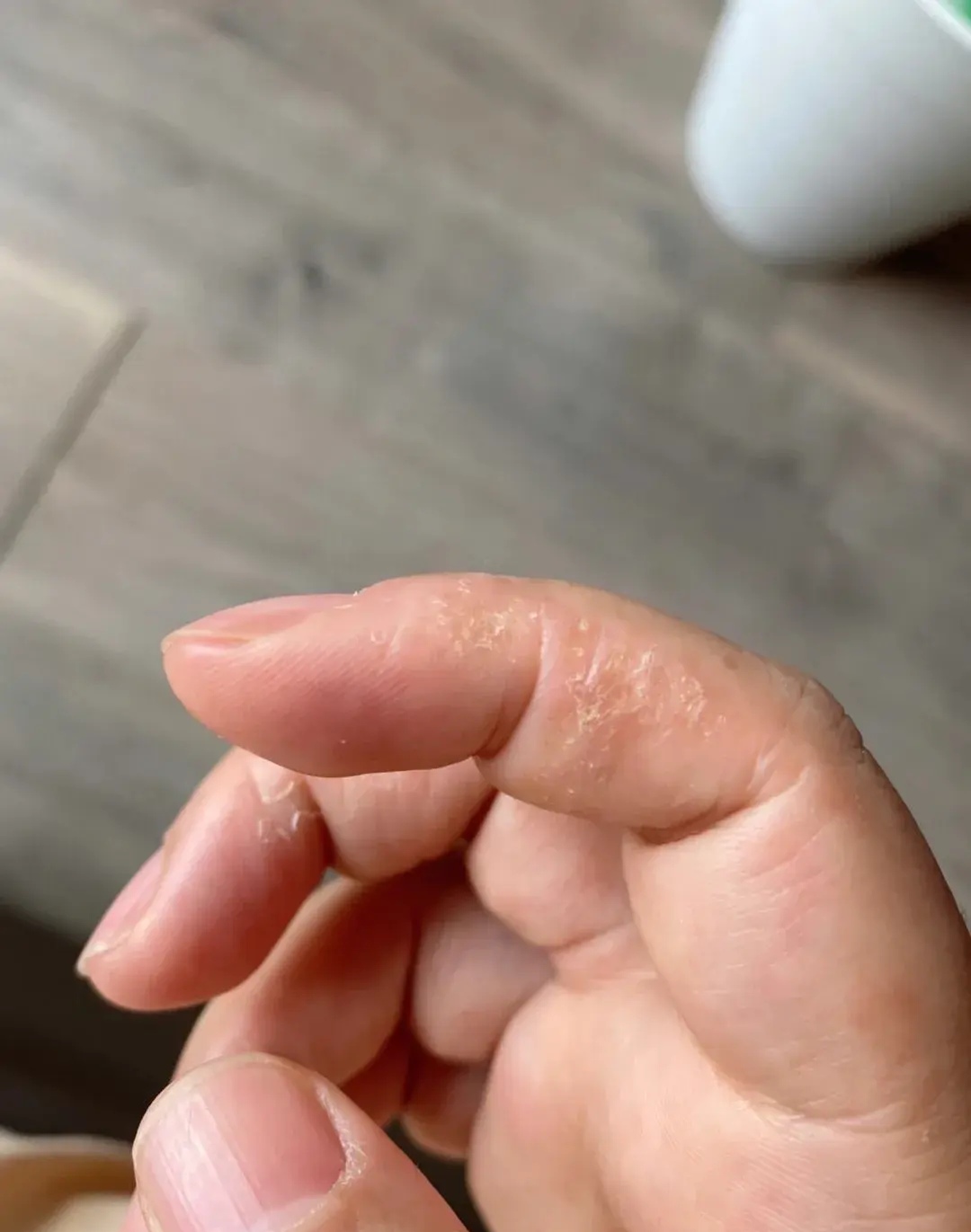 挤破小水泡之后还可以看到透明液体,这就是汗疱疹