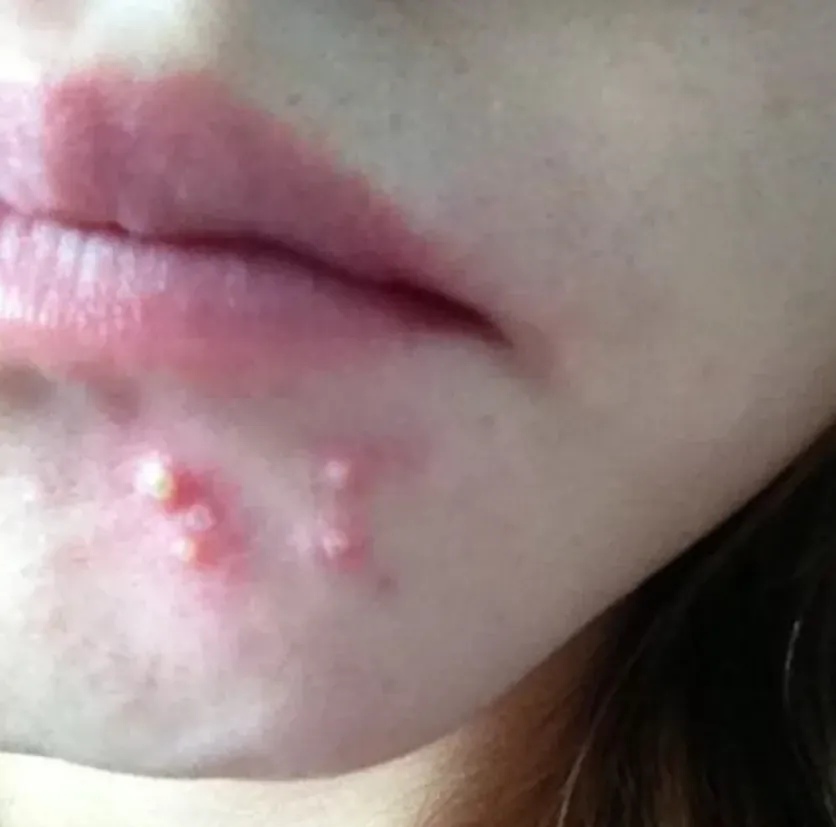 来姨妈长痘痘是为什么 来姨妈长痘痘是为什么