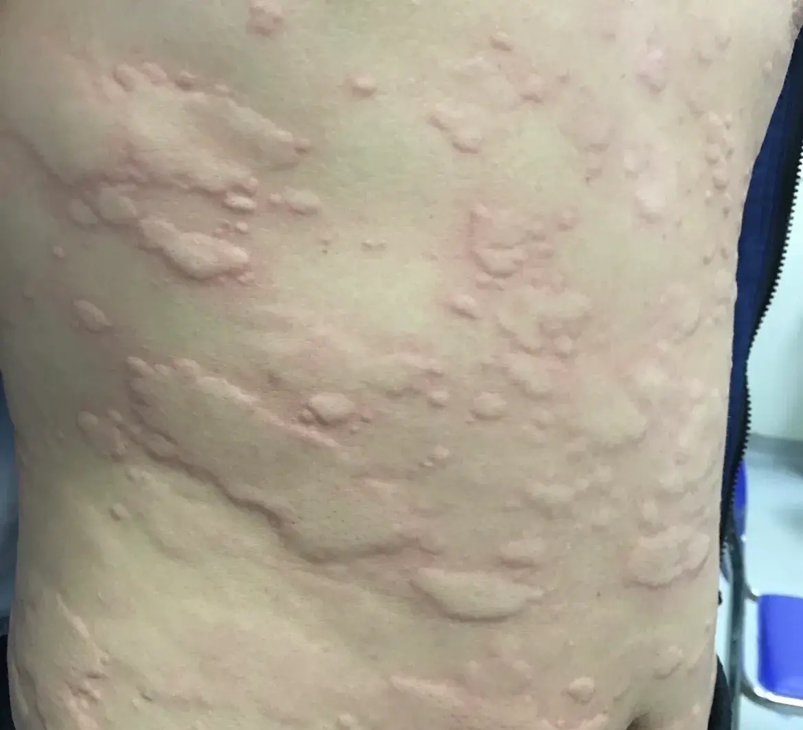 为什么会突然得了荨麻疹 为什么会突然得了荨麻疹