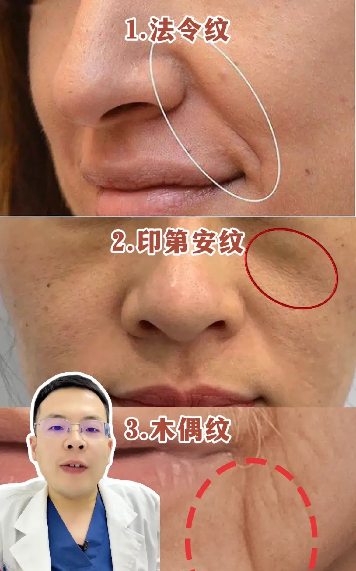 脸上出现三种纹,就是衰老的标志: 1,法令纹;2,印第安纹;3,木偶纹