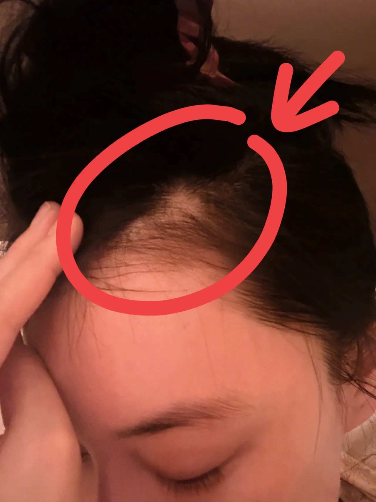 晒出斑秃照片头皮缺了一大块评论区心疼声一片?
