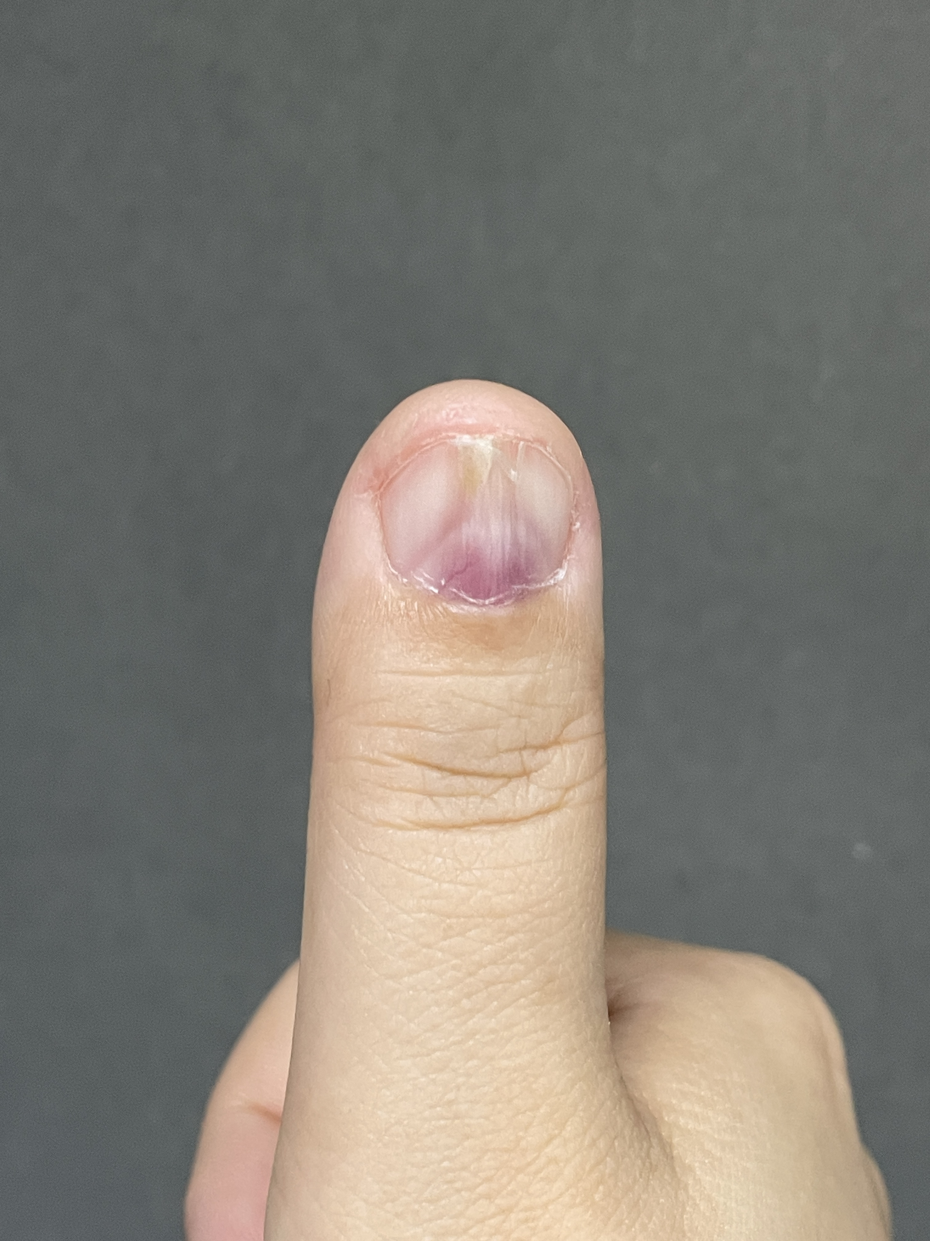 血管球瘤:了解这种不常见但重要的病变