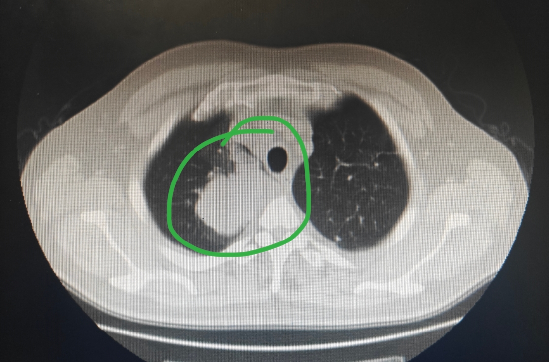 刘懿博士说肺癌(八四六四)六十岁可不算老,发现了五厘米肺占位  现在