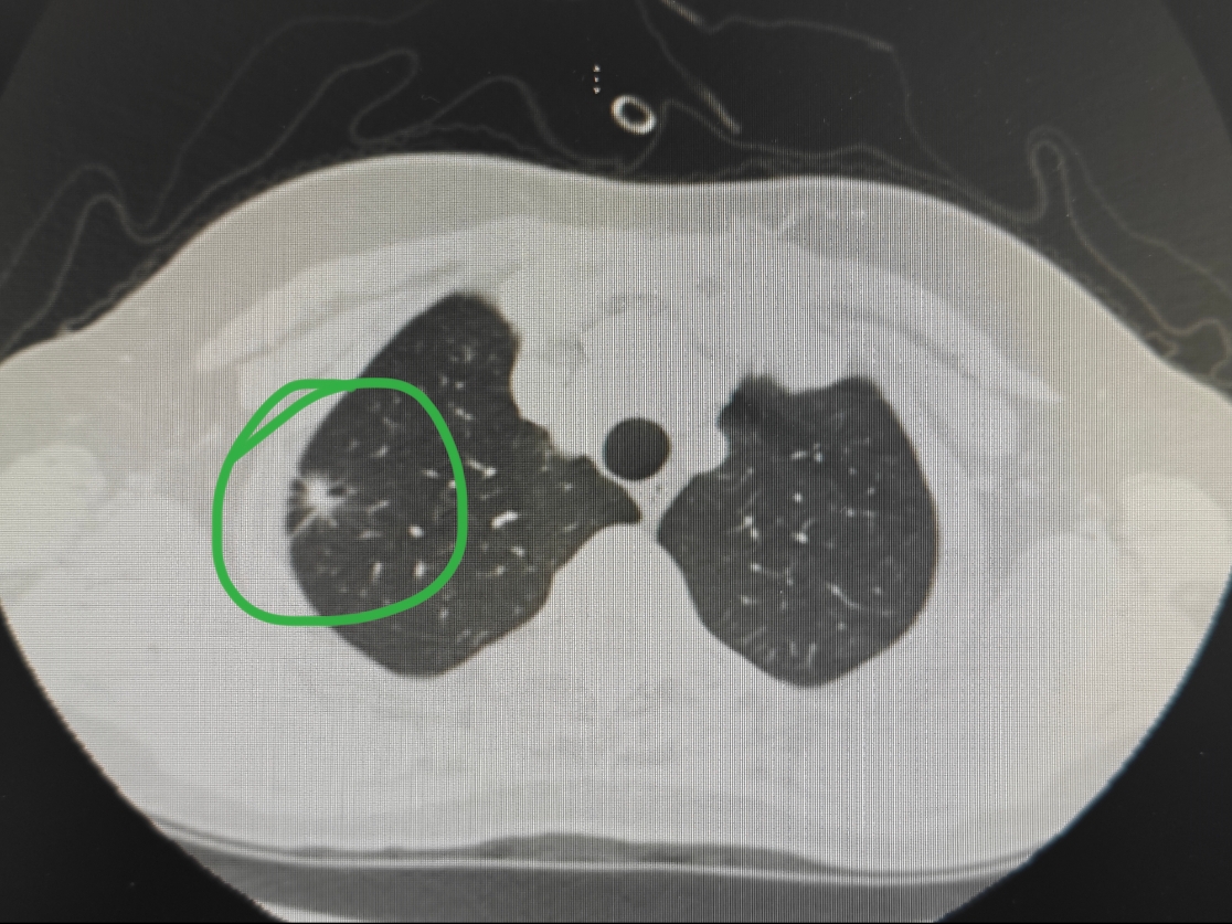 正常肺部ct图恶性肿瘤图片