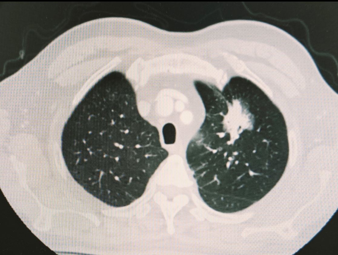 刘懿博士说肺癌(八六四五)肺部占位考虑恶性,肿瘤内科让找外科  有一