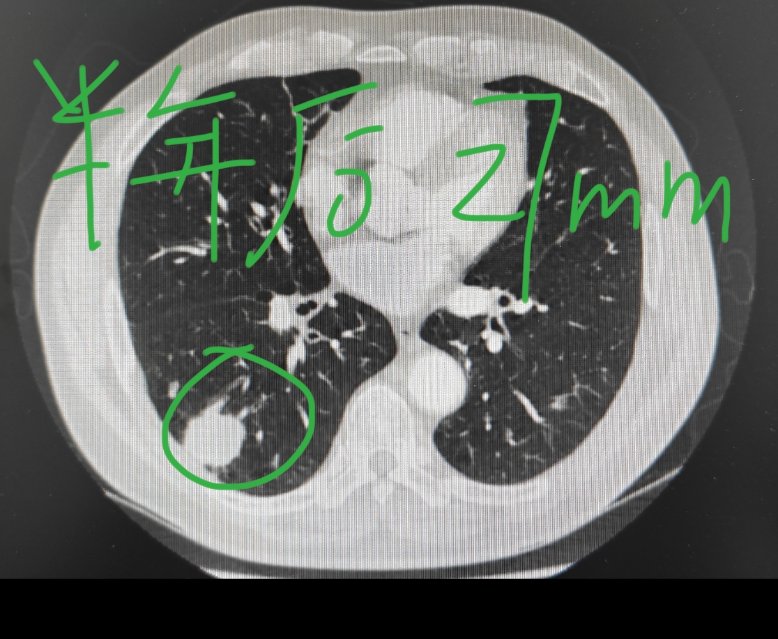 刘懿博士说肺癌(八六五八)肺结节从21长到了27毫米体积增大多少  前段