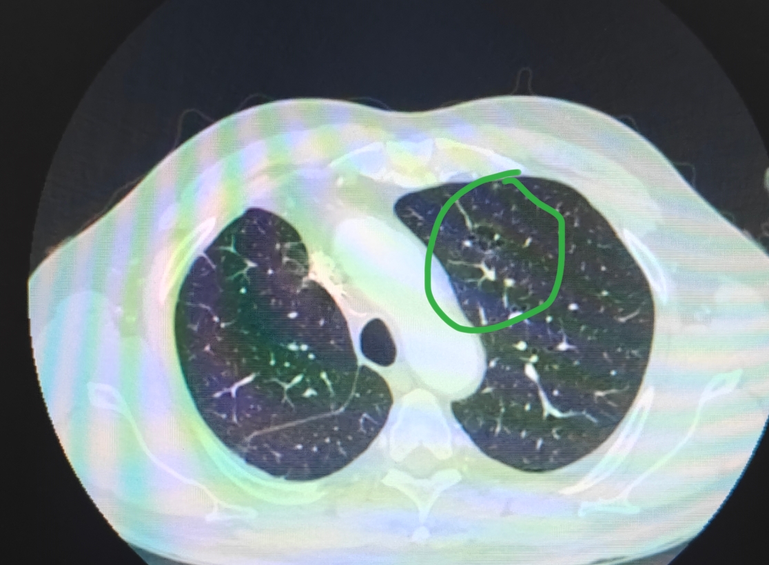 刘懿博士说肺癌(八六七八)这个病灶可不是肺大泡而是恶性肿瘤  大家都