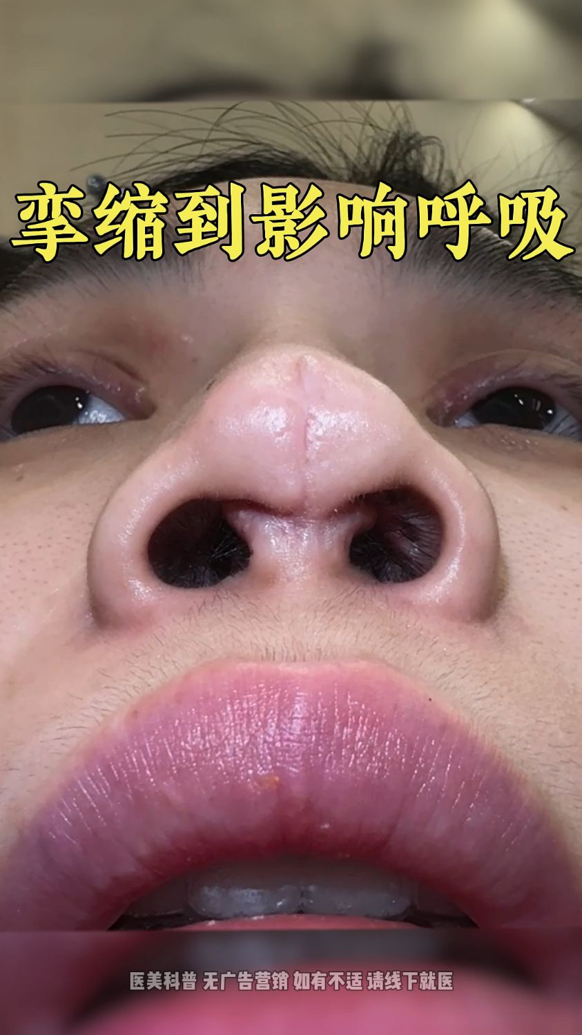 鼻子反复感染,挛缩到影响呼吸!