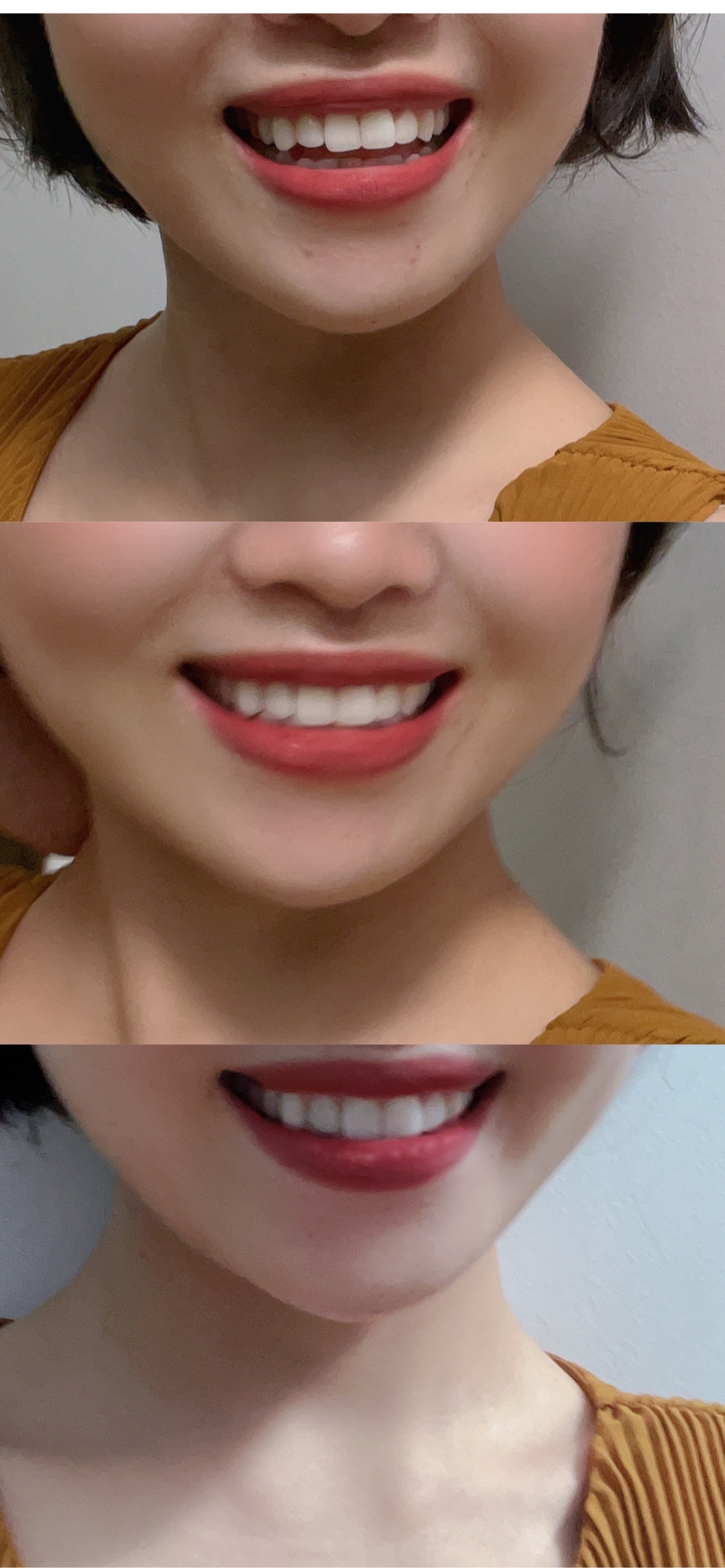 牙齿不整齐有什么危害?