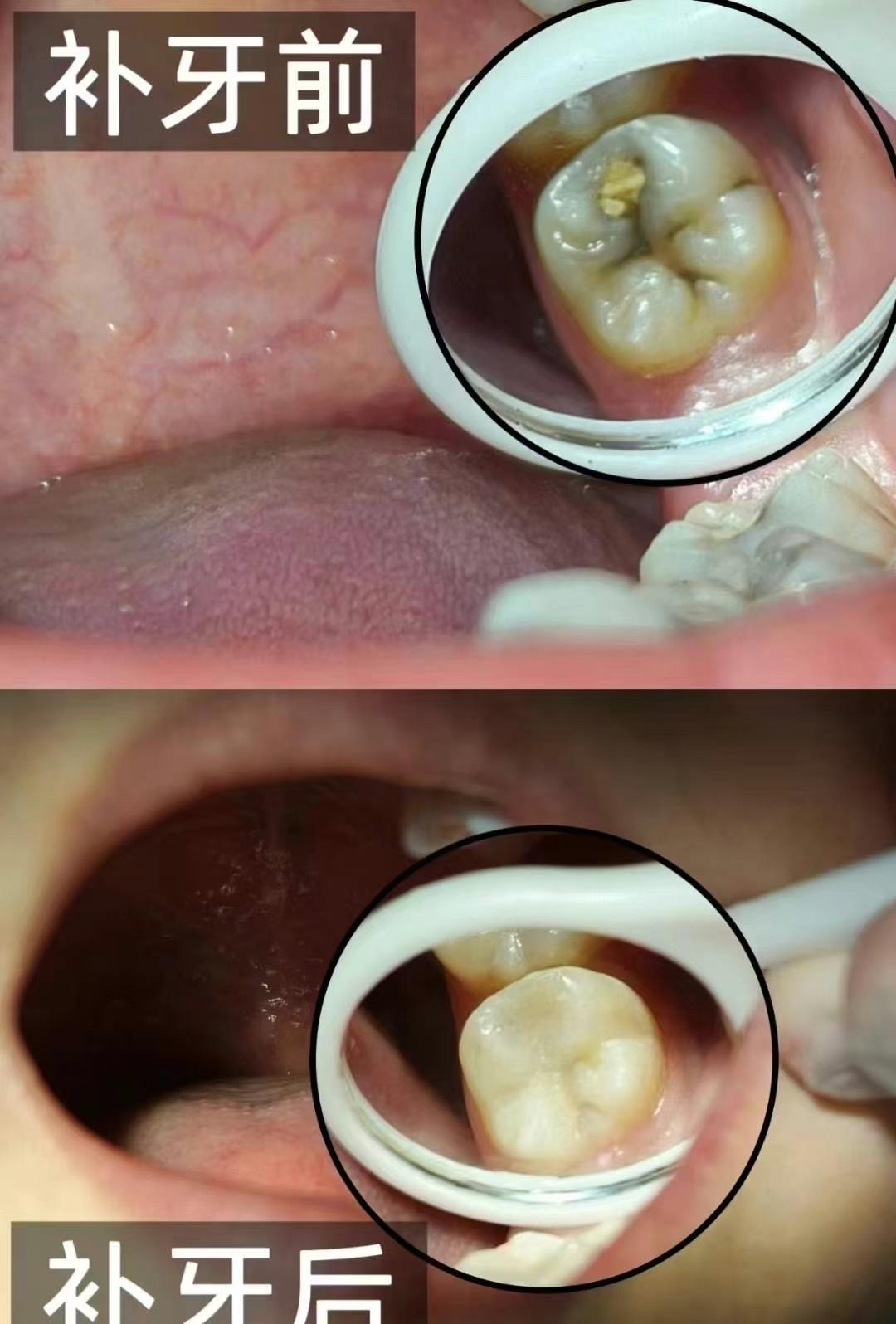 因为修补后的龋洞能阻止病变发展,迅速恢复牙齿功能,保持牙列完整