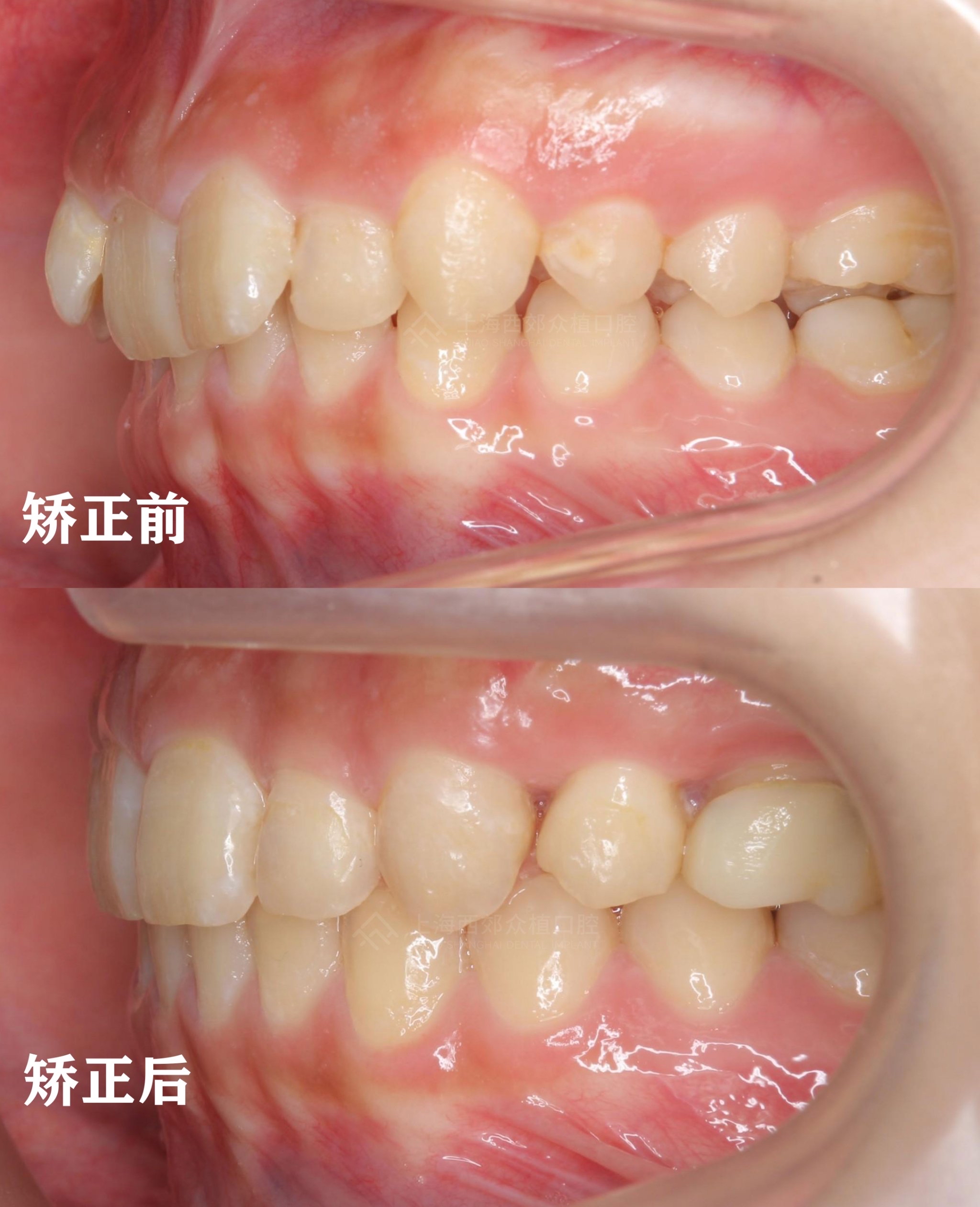 导致青少年牙齿深覆合的原因 1,不良口腔习惯:例如有经常咬下唇,紧咬