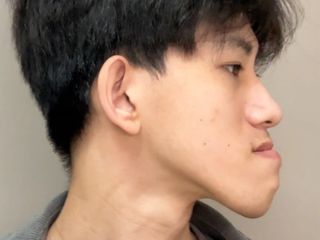 儿童地包天的3种矫治器选择