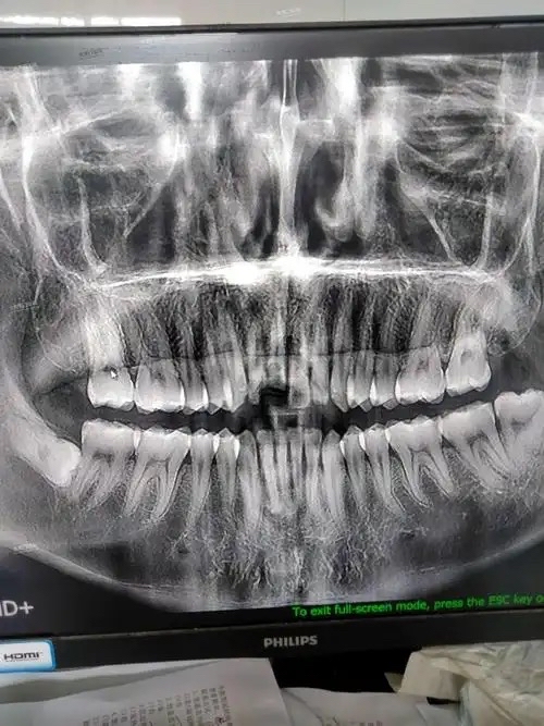 根管治疗时,拍牙片是很有必要的,并且至少要保证3张牙片
