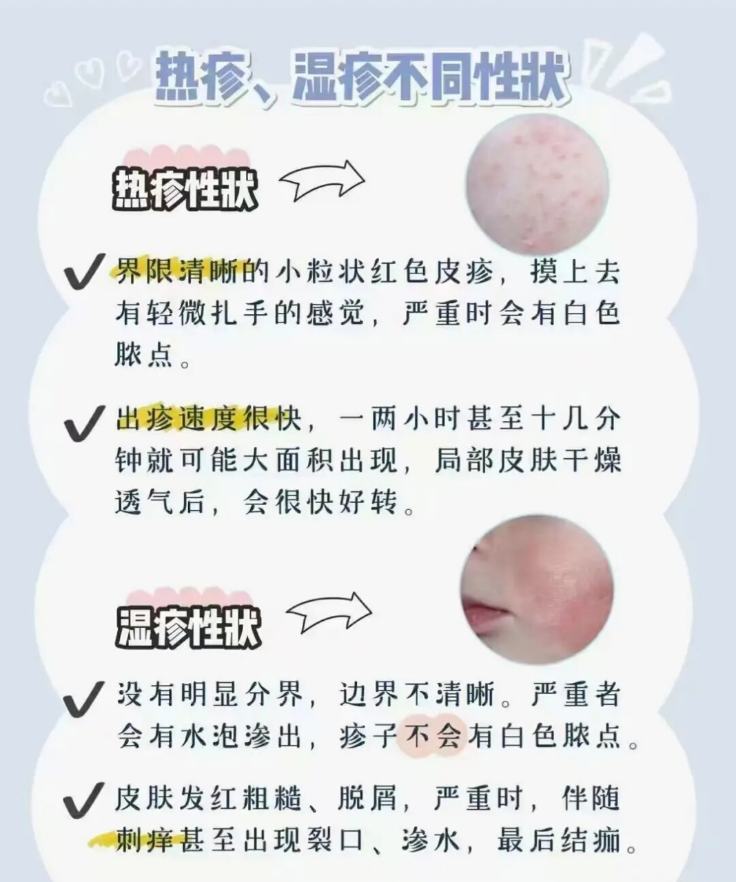 婴儿热疹和湿疹的区别