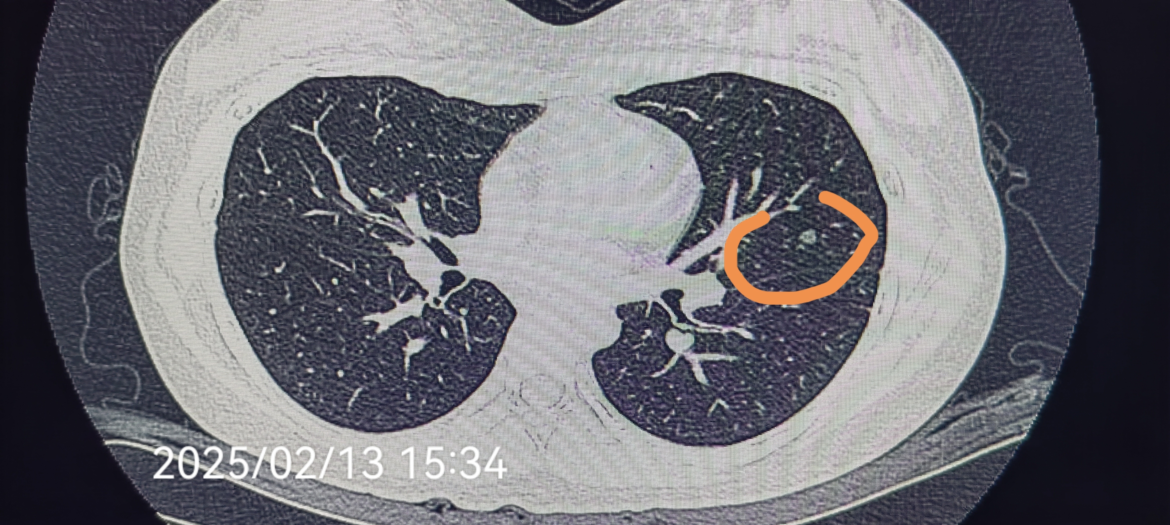 14岁初三女孩肺磨玻璃结节