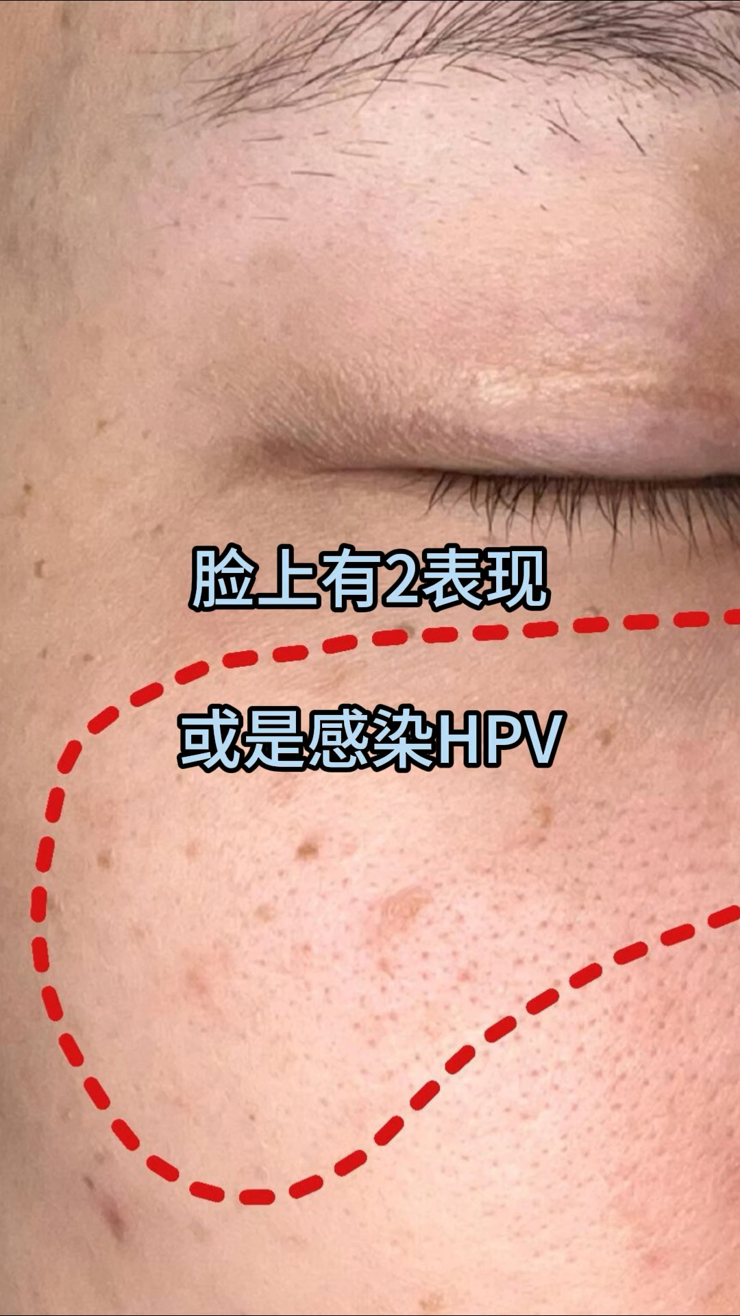 脸上有2表现,或是感染hpv.