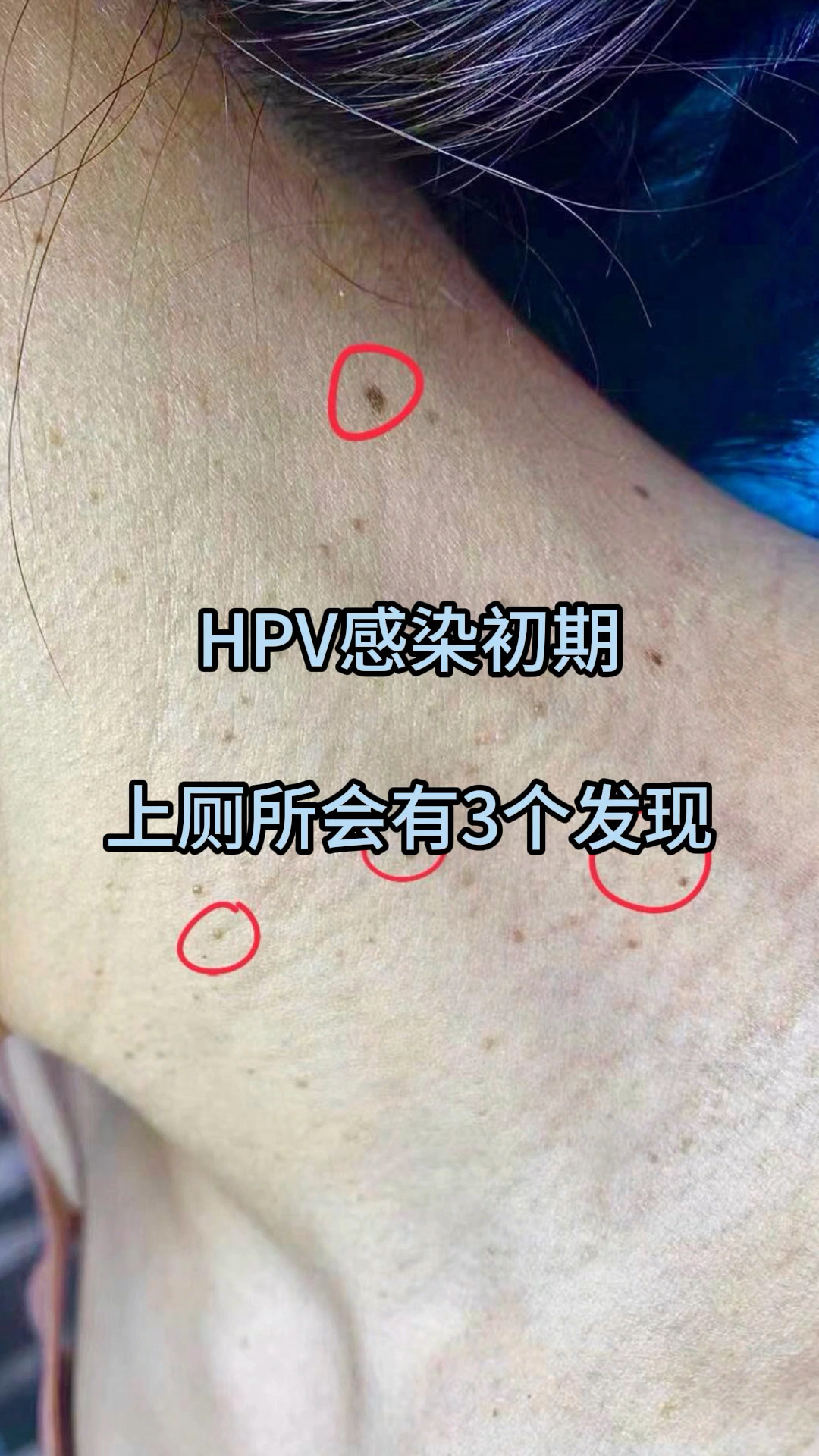 hpv感染初期,上厕所会有3个发现