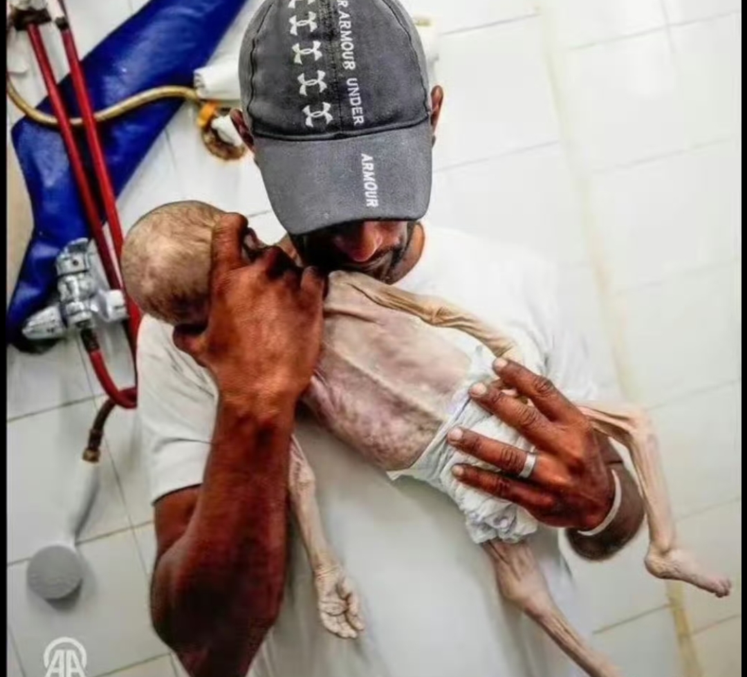 加沙,母亲被以色列炸死,没有奶水饿到瘦骨嶙峋的婴儿