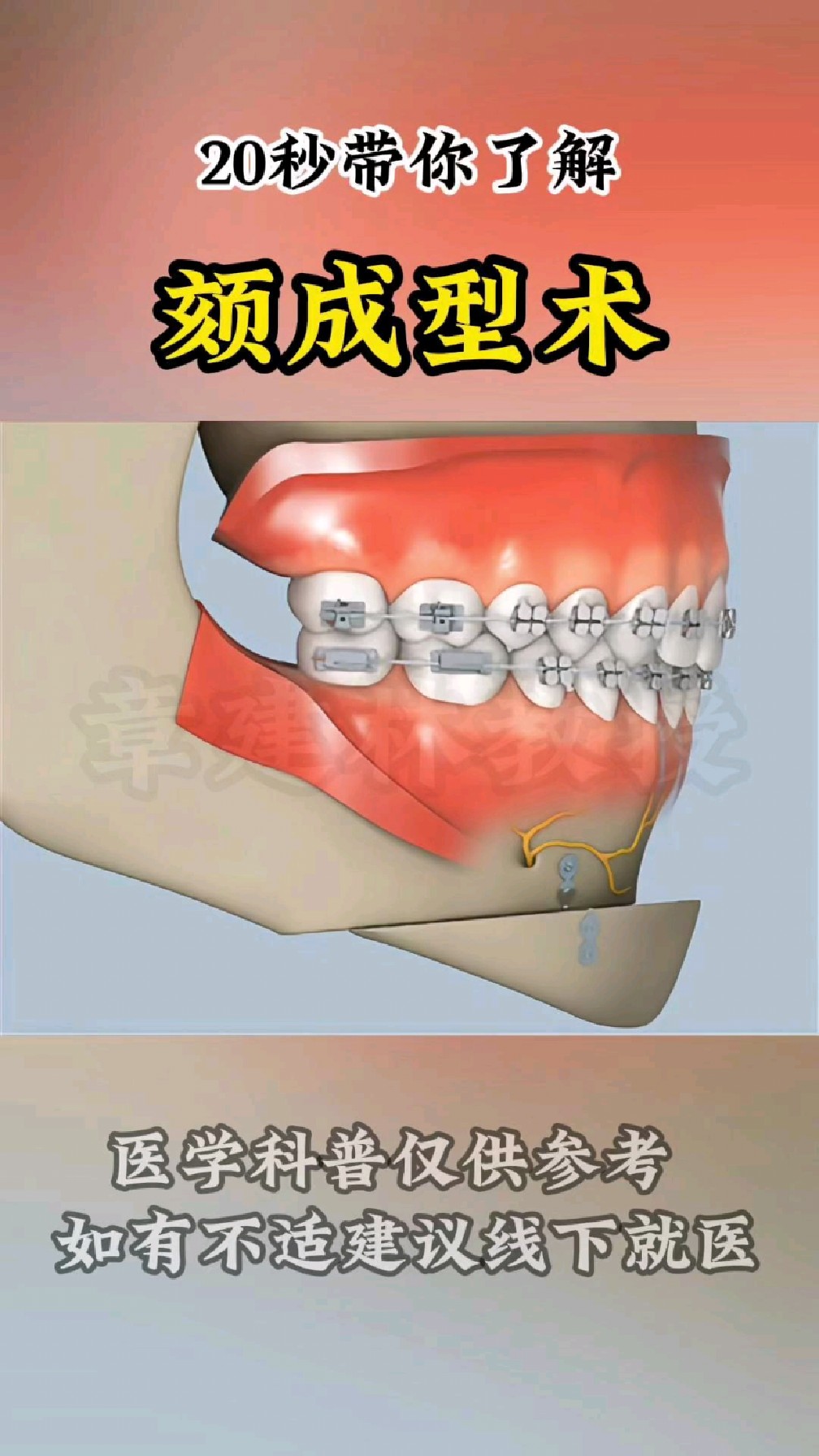 20秒带你了解颏成形术!