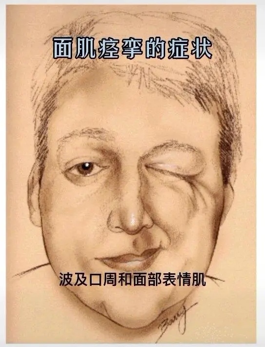 聊一聊面肌痉挛这个病 面肌痉挛