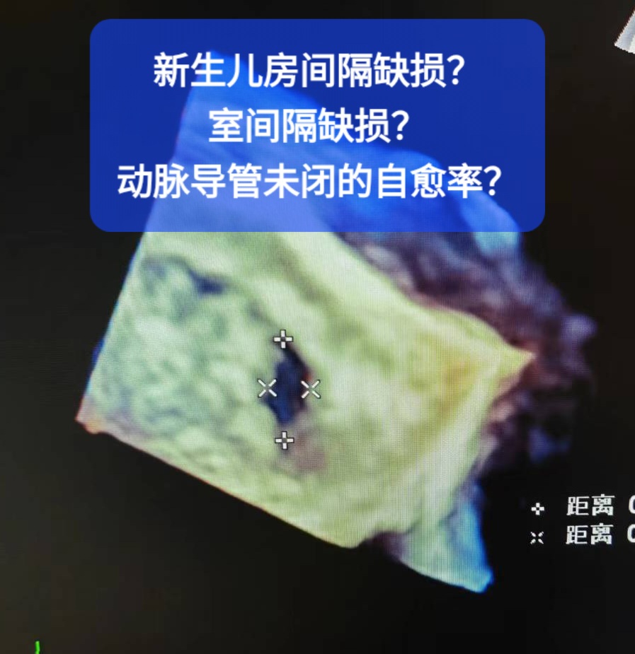 新生儿房间隔缺损图片