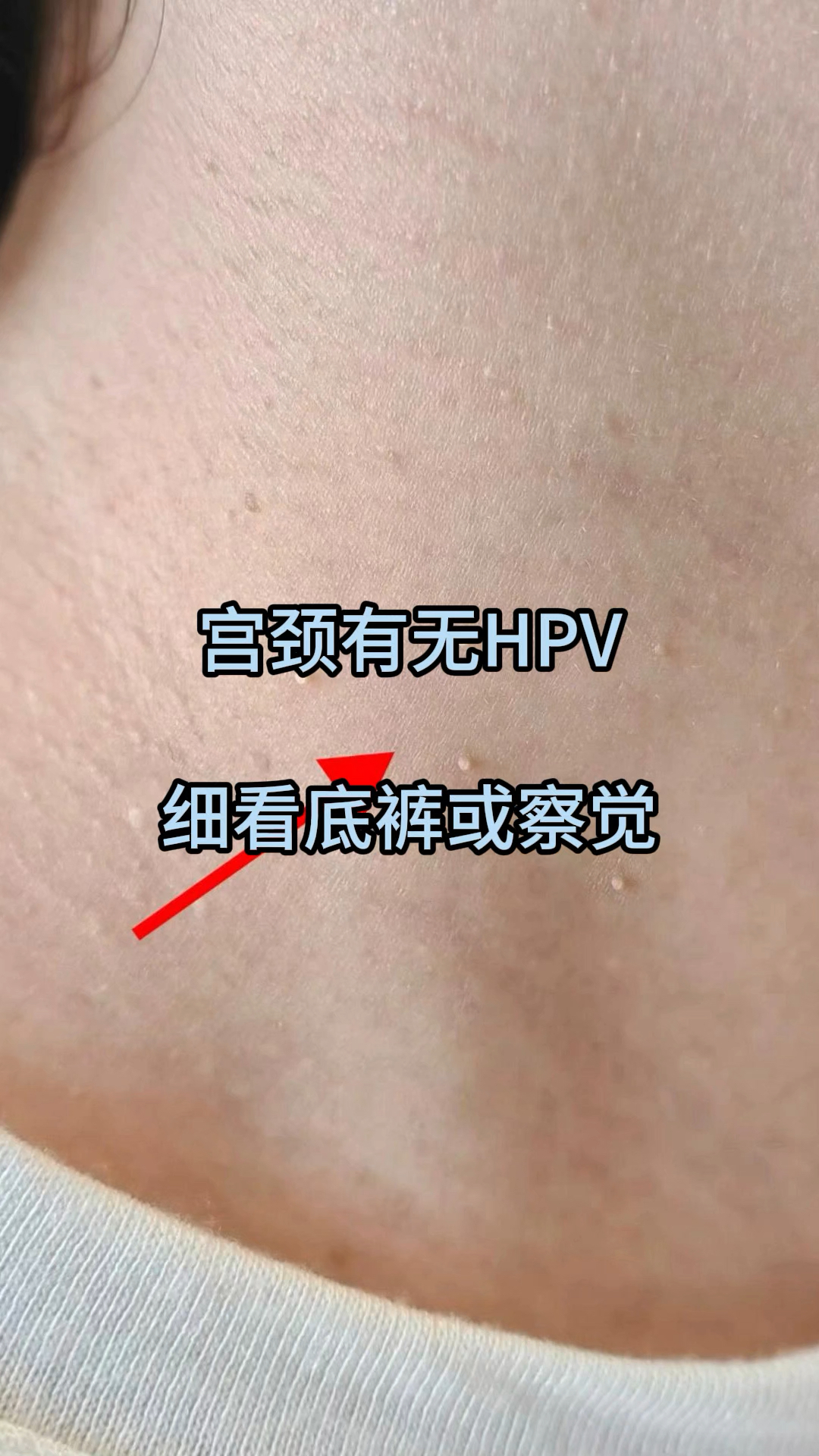宫颈有无hpv,细看底裤或察觉