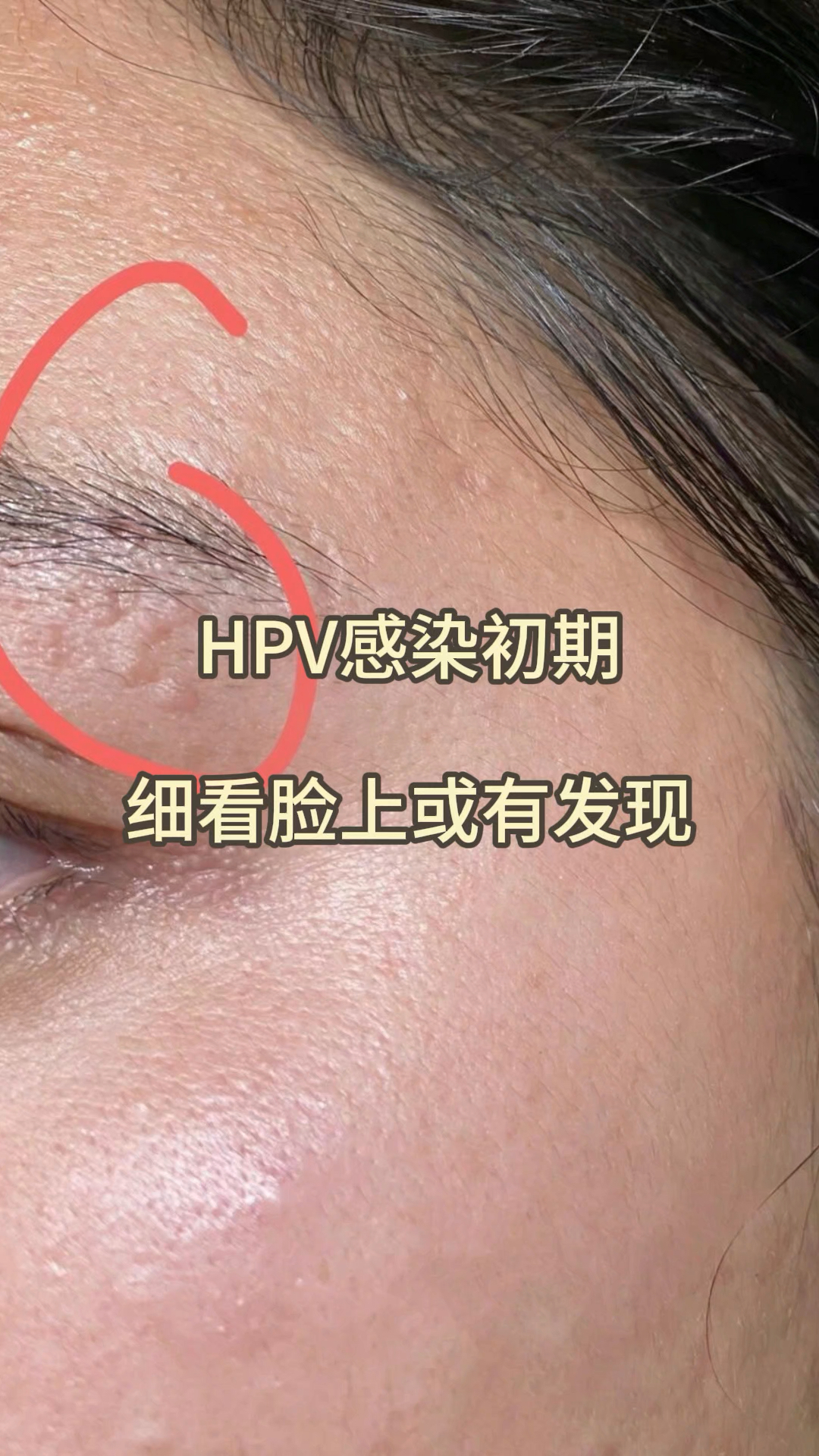 HPV是怎么感染的 早期图片