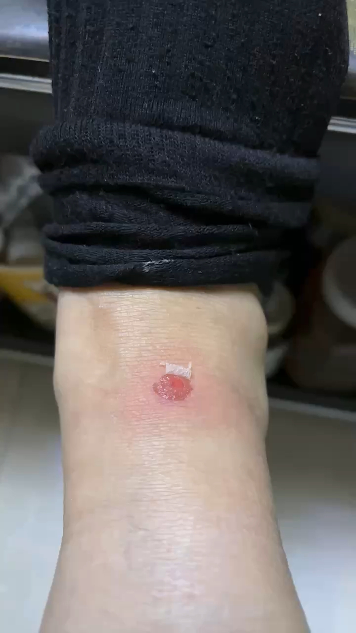 腿腿破了好久也好不了真是郁闷死了,太气人啦