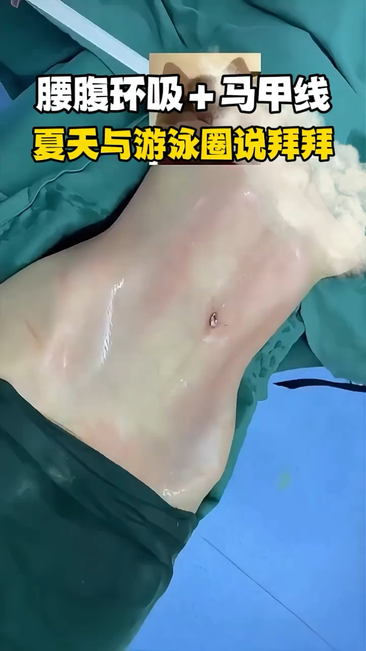 腰腹环吸多久恢复图片