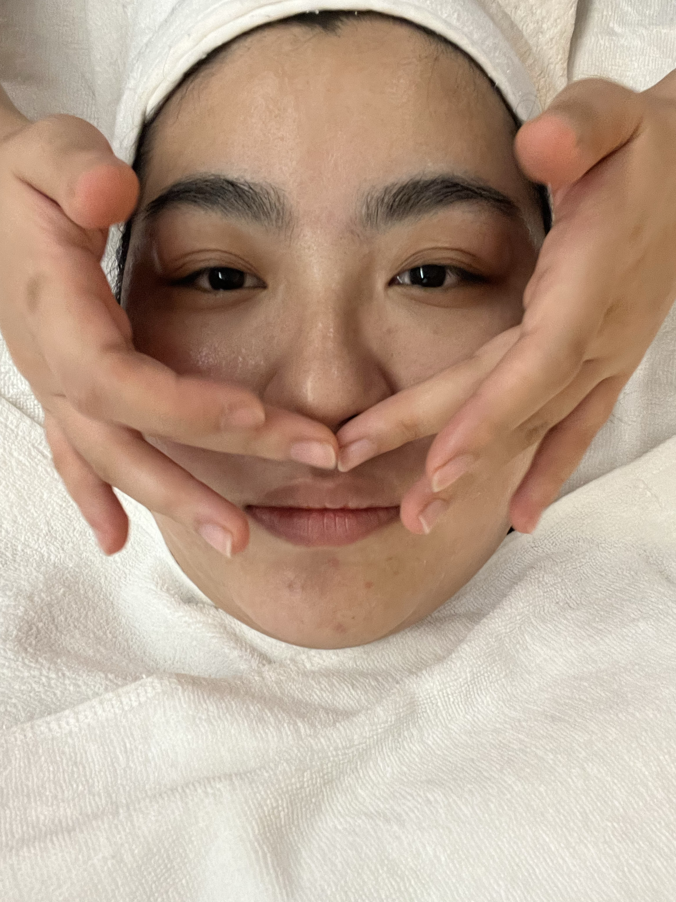 这次我来体验水杨酸祛痘据说这是一个对于油痘肌太阳穴凹陷祛痘对比