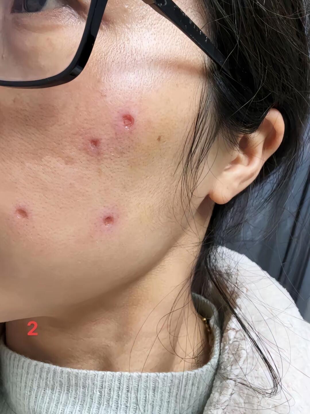 激光点痣之后怎么样才能够恢复的更快?