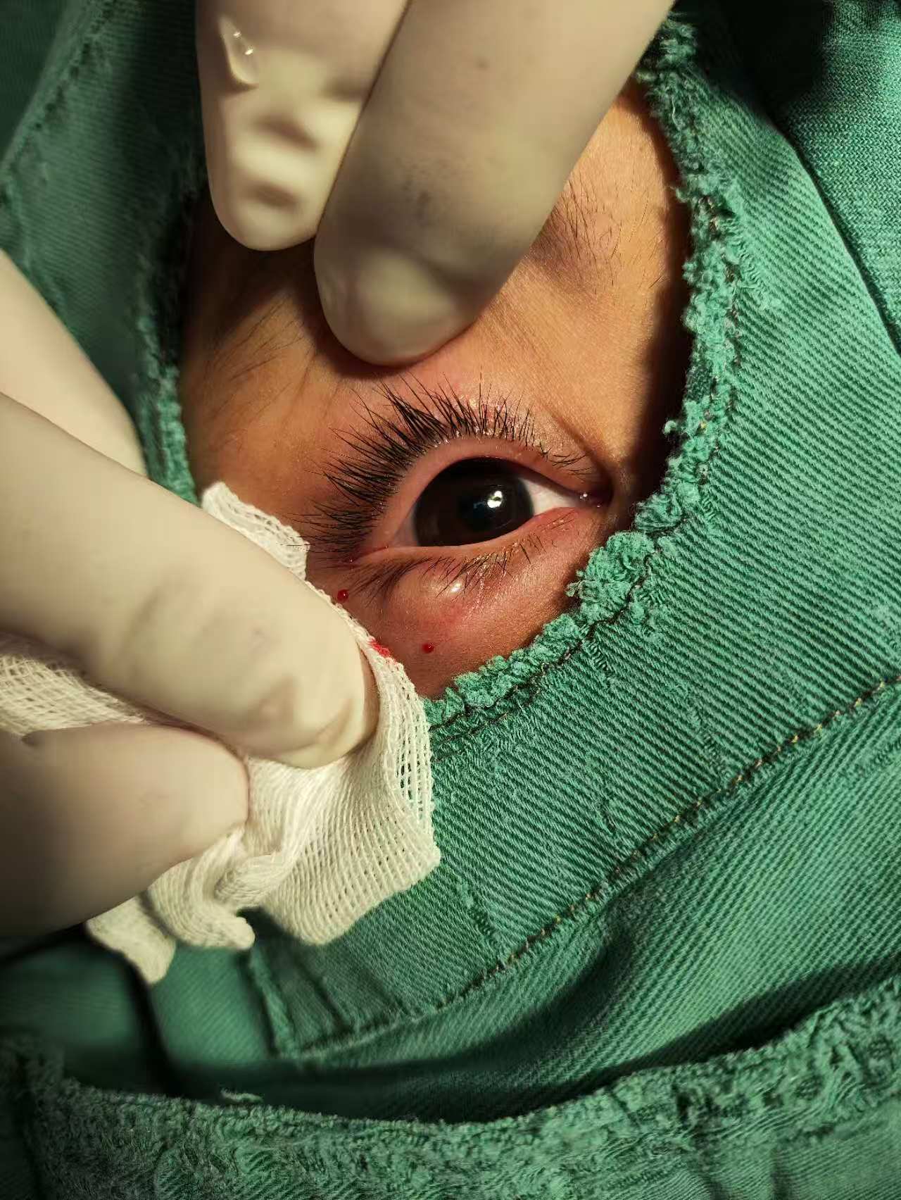 2个月,忽大忽小,始终不消除,小姑娘很坚强,局麻下清除脓及炎性组织