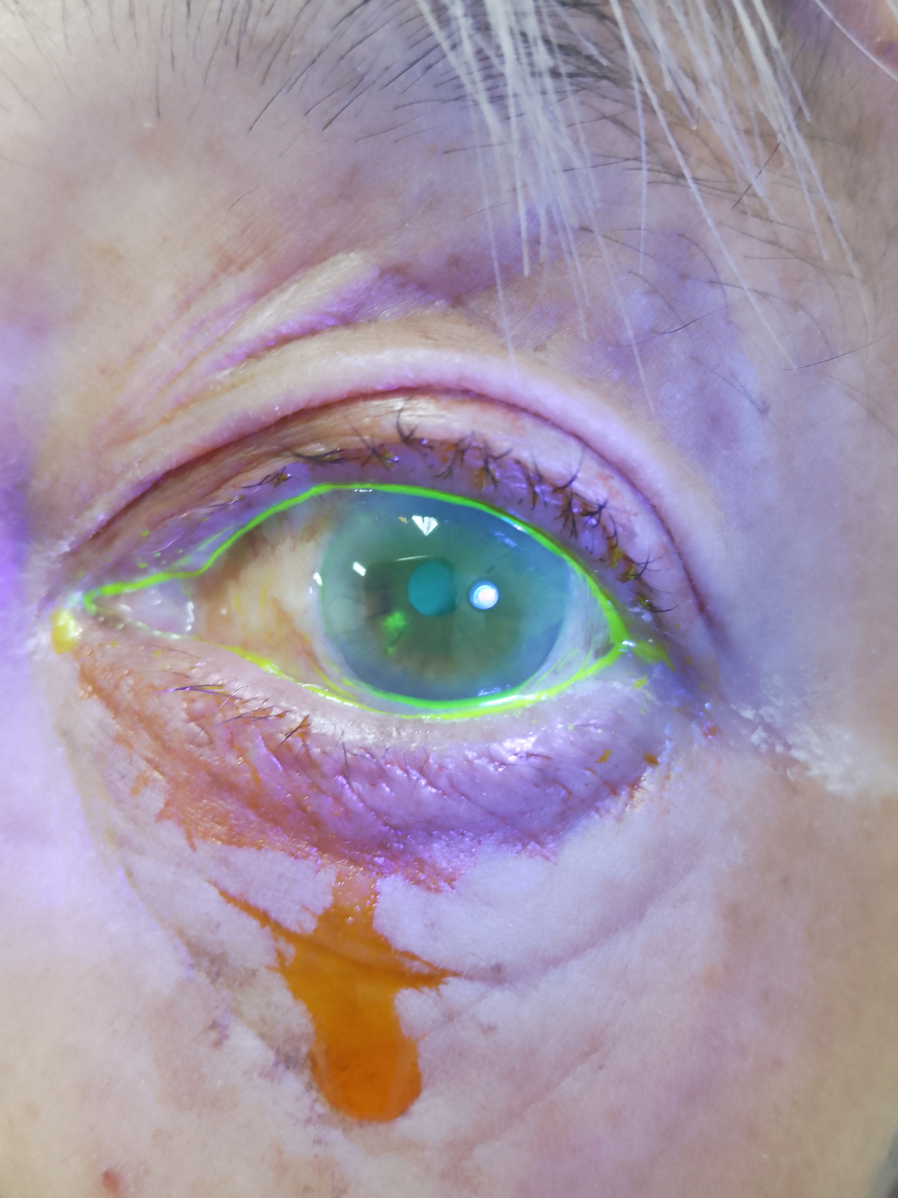 荧光染色可以明确上皮树枝状缺损,病毒性角膜炎明确,抗病毒治疗即可