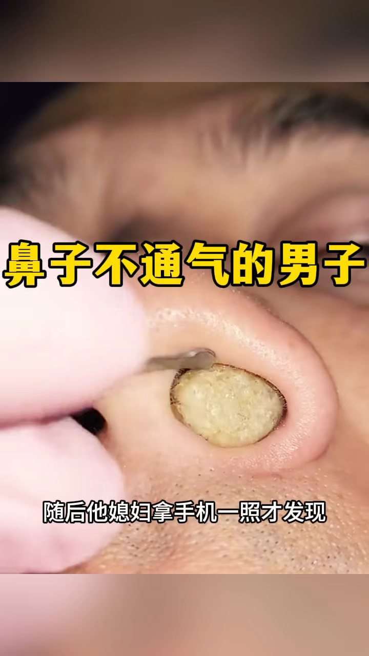 鼻子不通气的男子,原来是卡住东西了